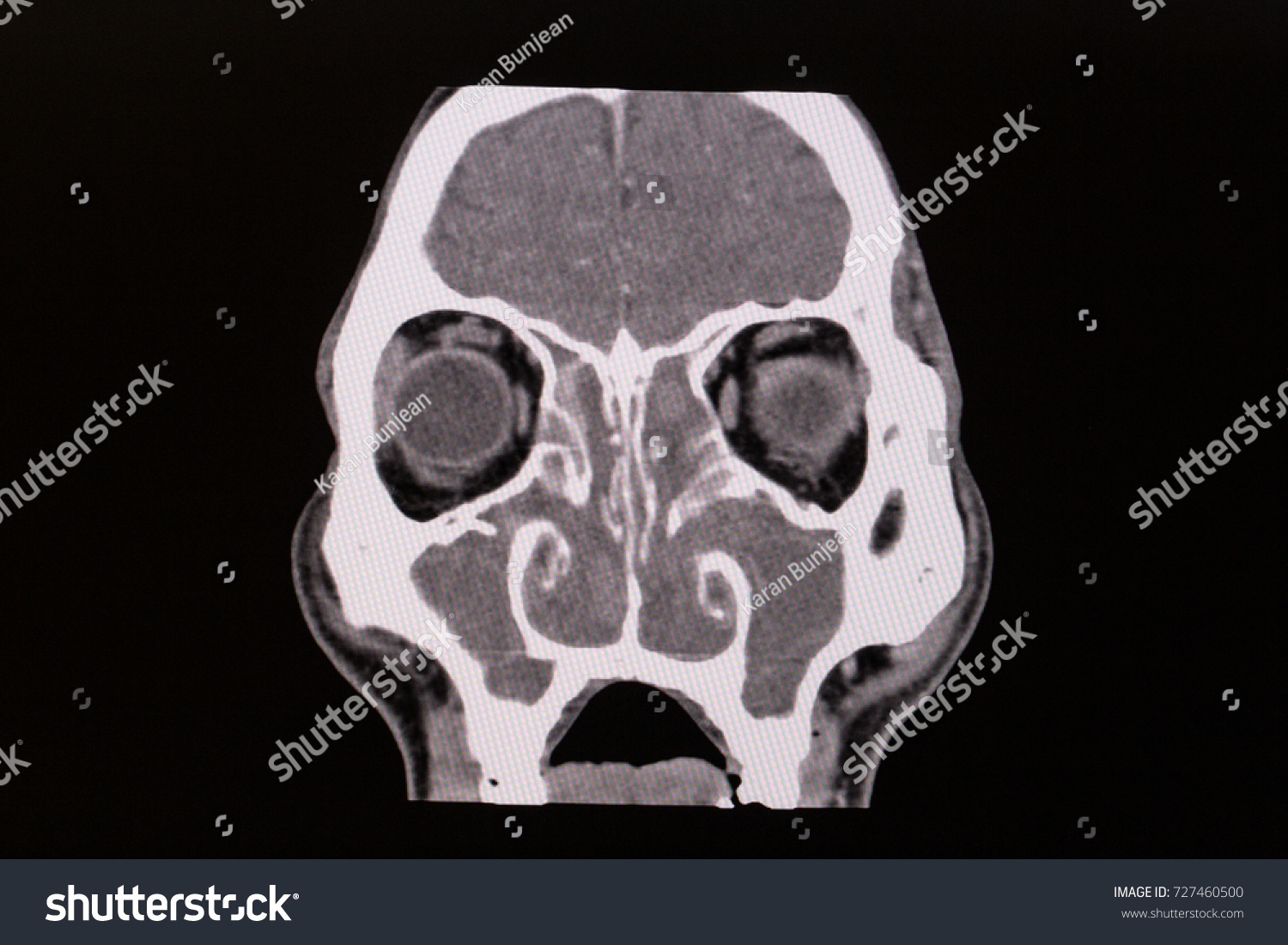 Zooming Closeup View Ct Scan Head Stock Photo 727460500 | Shutterstock