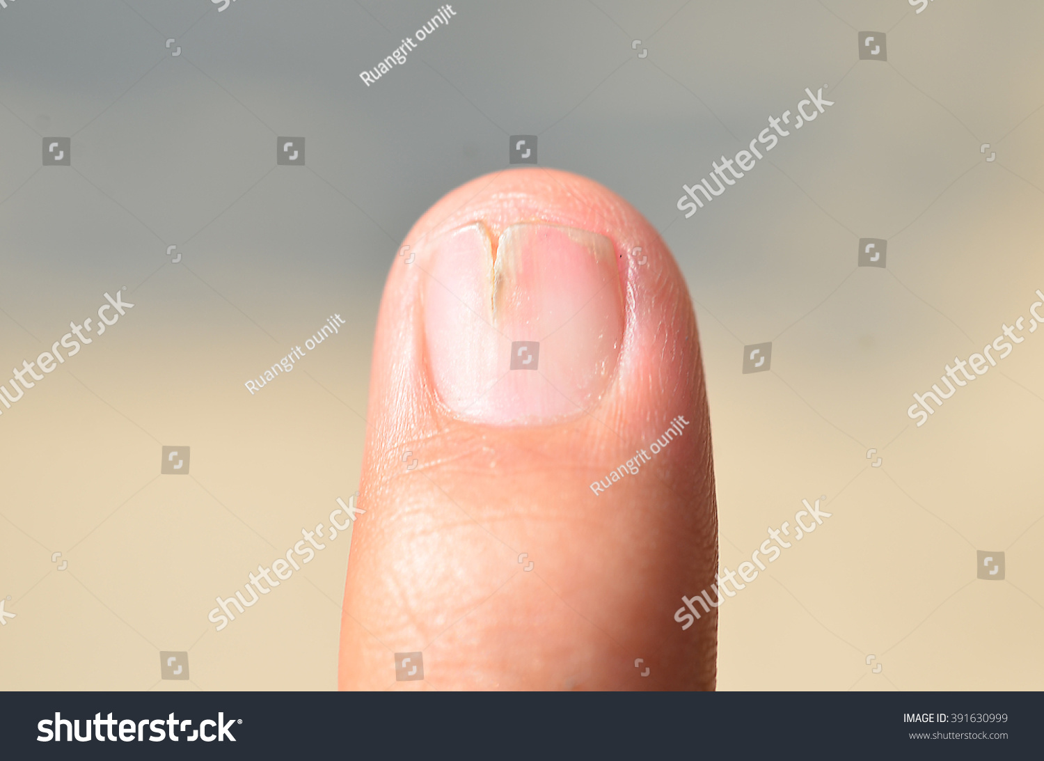 Zoon Abnormal Finger Stock Photo 391630999 - Shutterstock