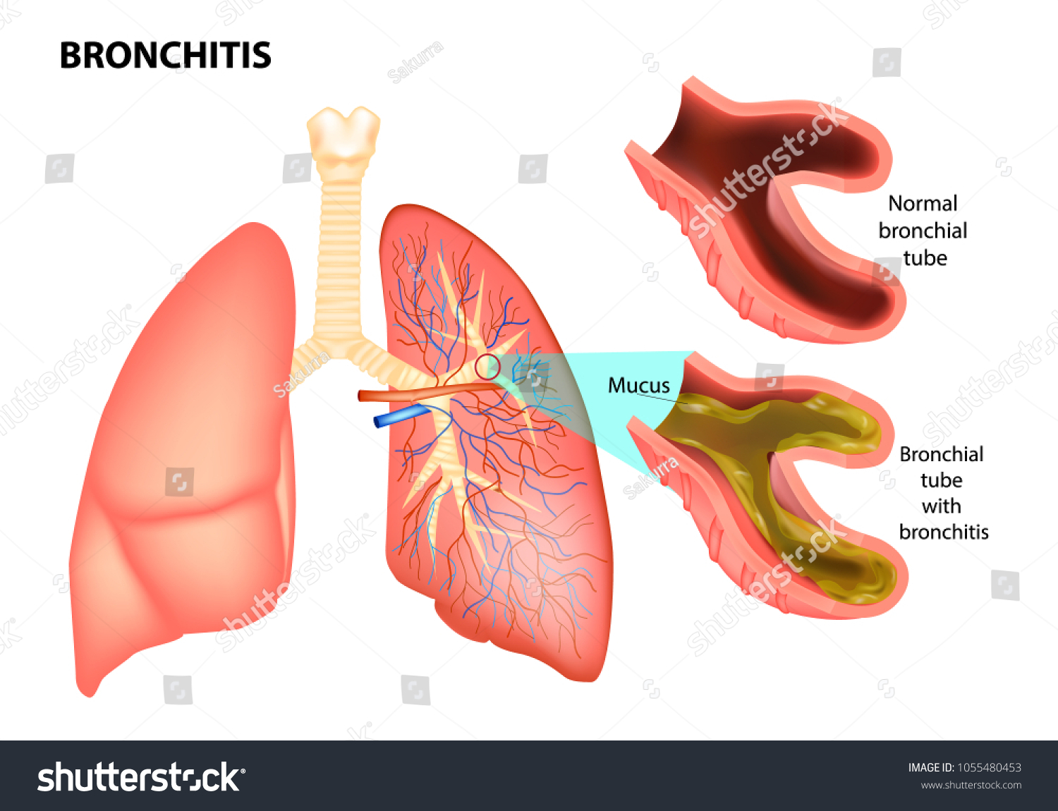 Bronchitis Is Bronchitis