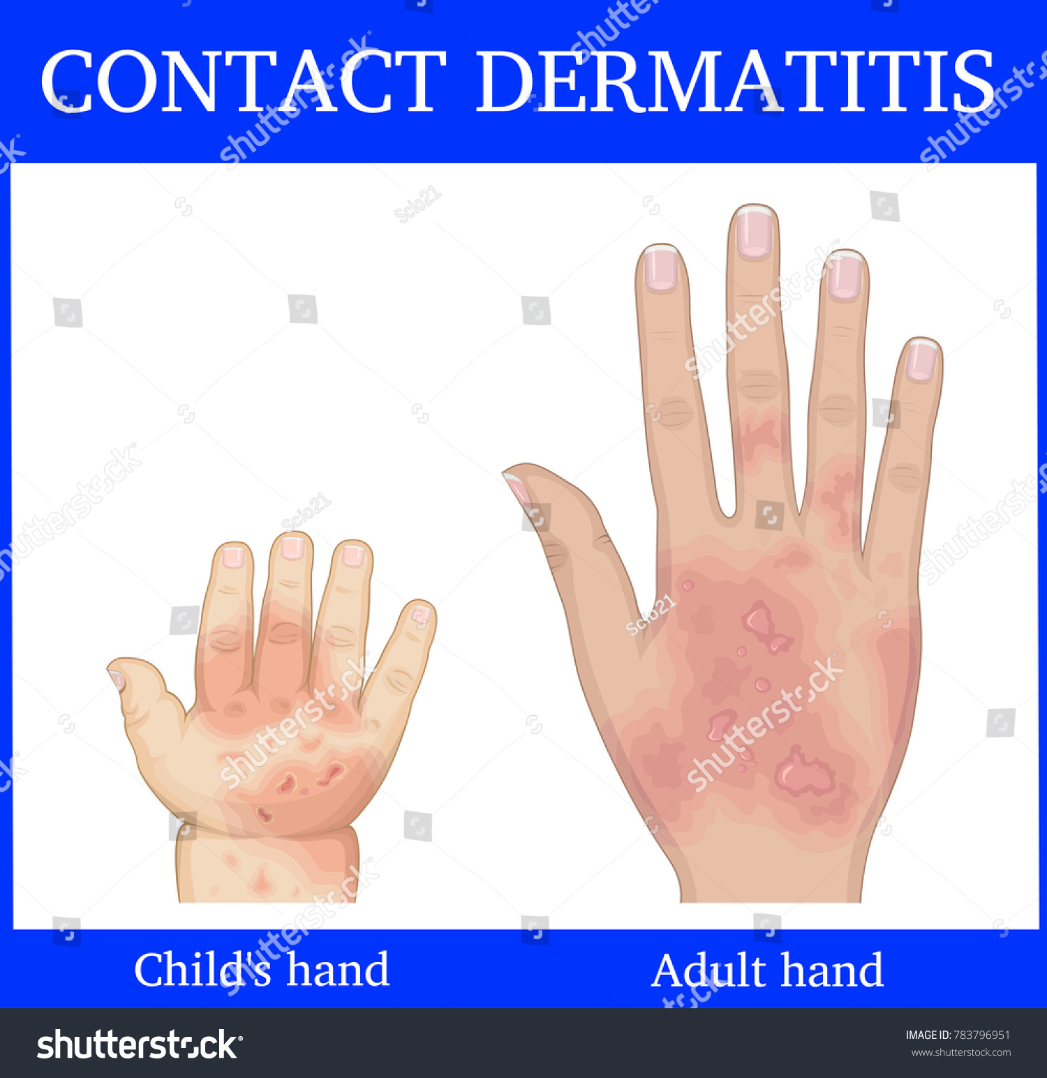 Allergic Contact Dermatitis Images, Stock Photos & Vectors | Shutterstock