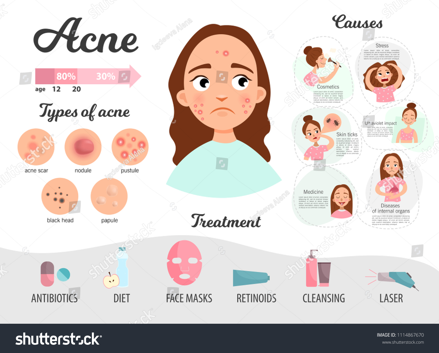 Vektor Stok Acne Types Causes Treatment Infographics Vector Tanpa Hot