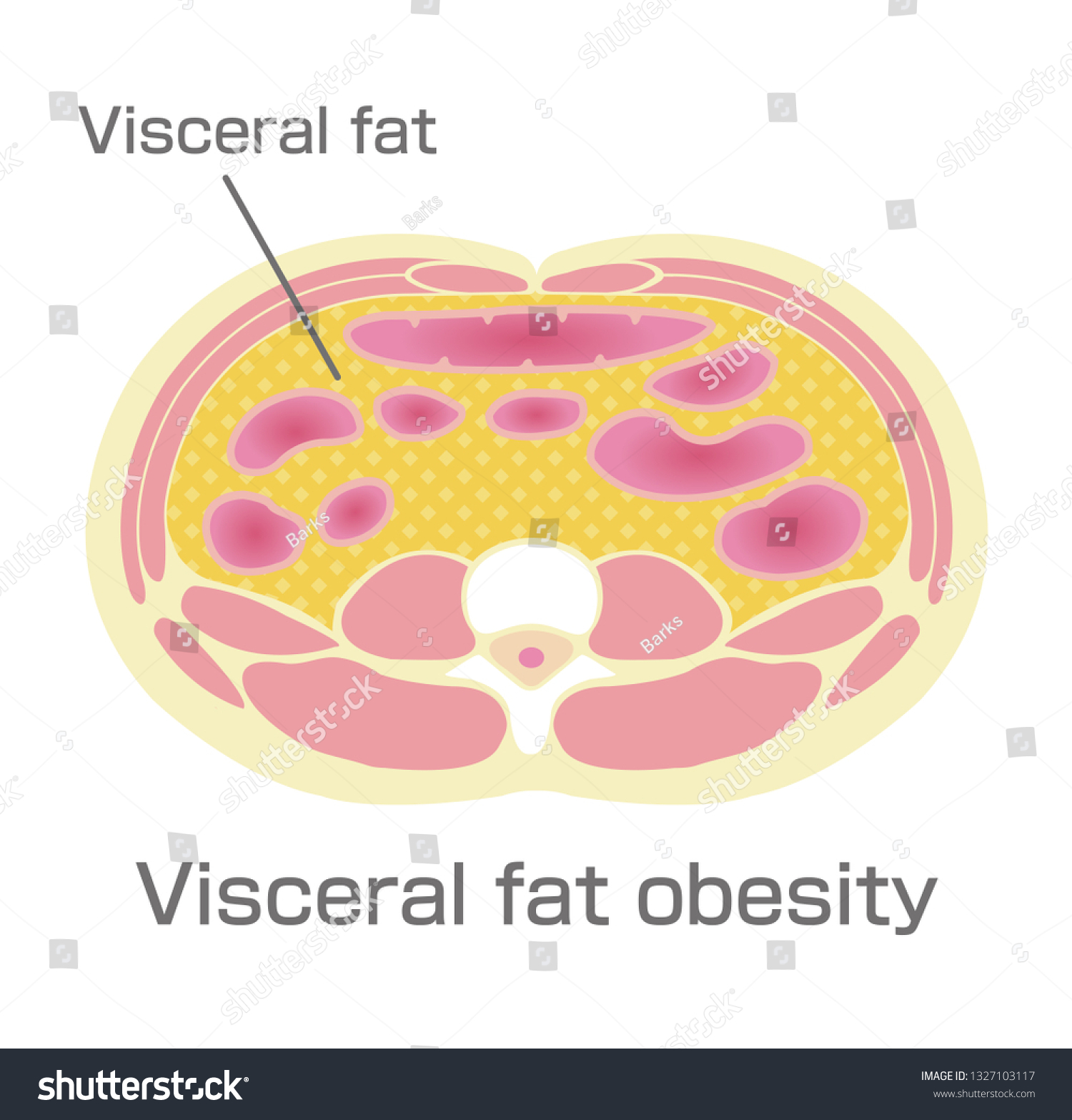 Type Obesity Illustration Abdominal Sectional View Stock Vector ...