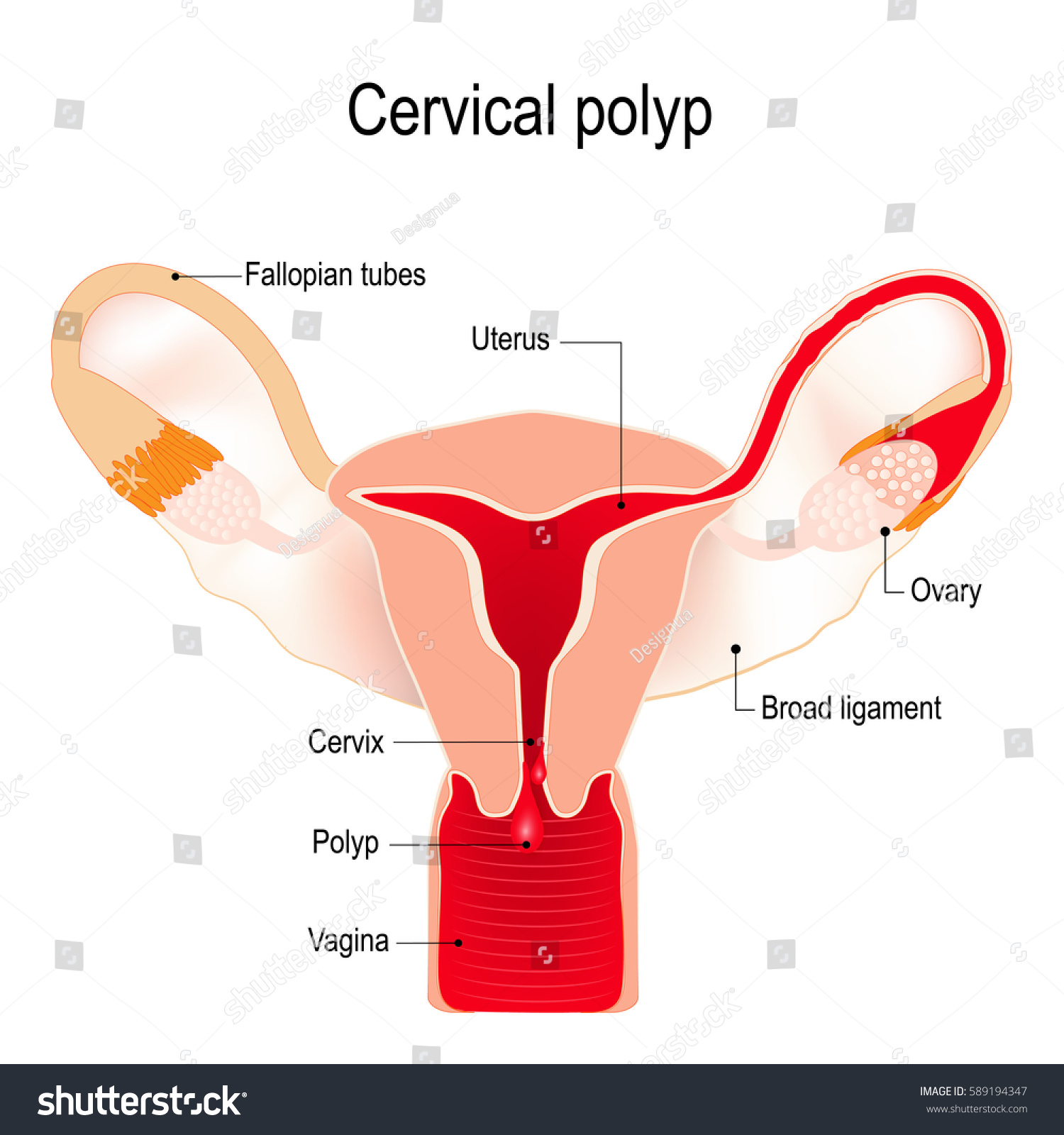 Cervical Polyp Tumour On Surface Cervical Stock Vector (Royalty Free ...