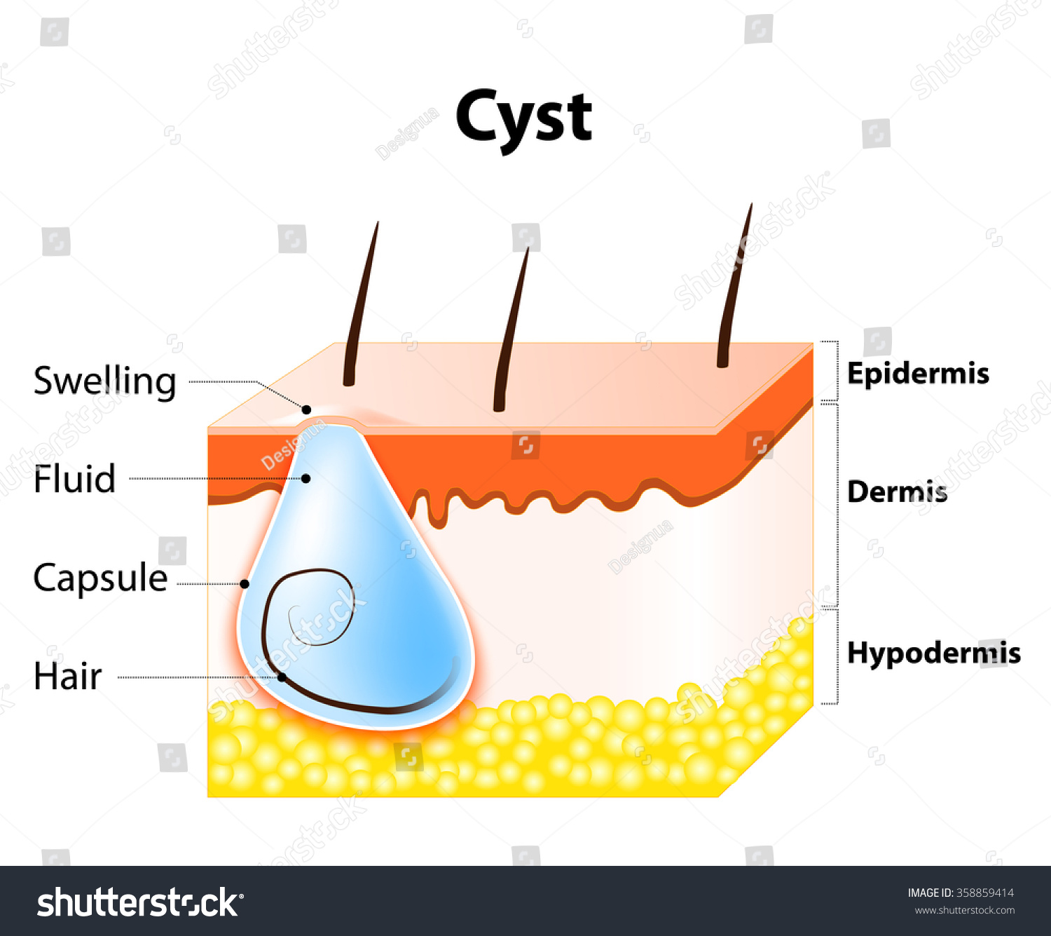 Cyst Epitheliallined Cavity Containing Liquid Other Stock ... pilar cyst diagram 