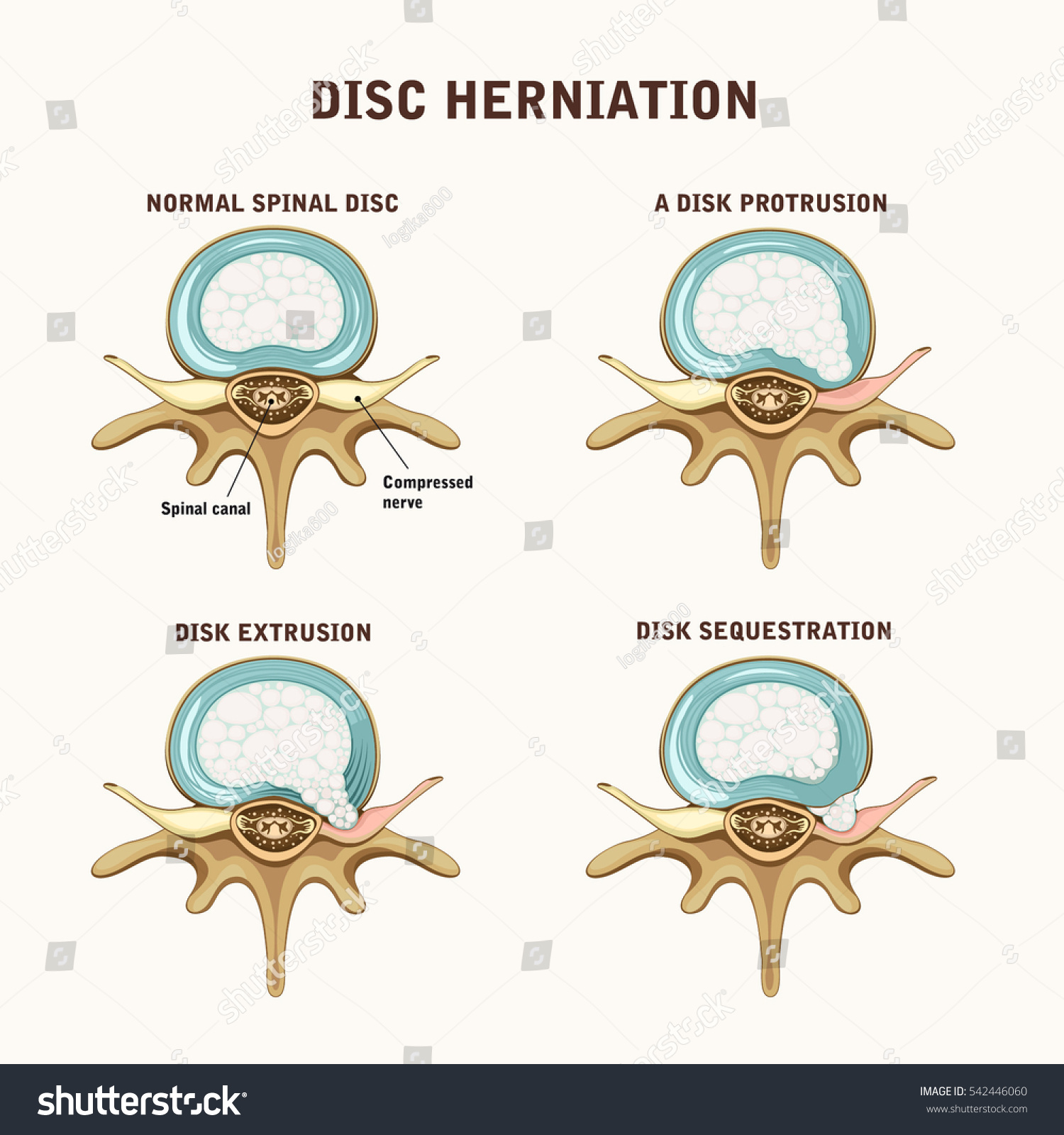 Herniated Spinal Disc Normal Protrusion Extrusion Stock Vector