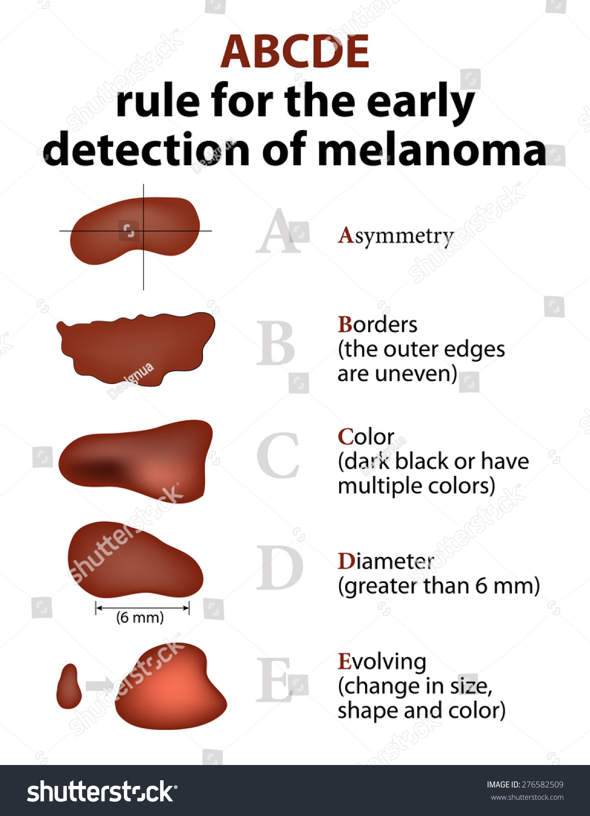 Melanoma Abcde Rule