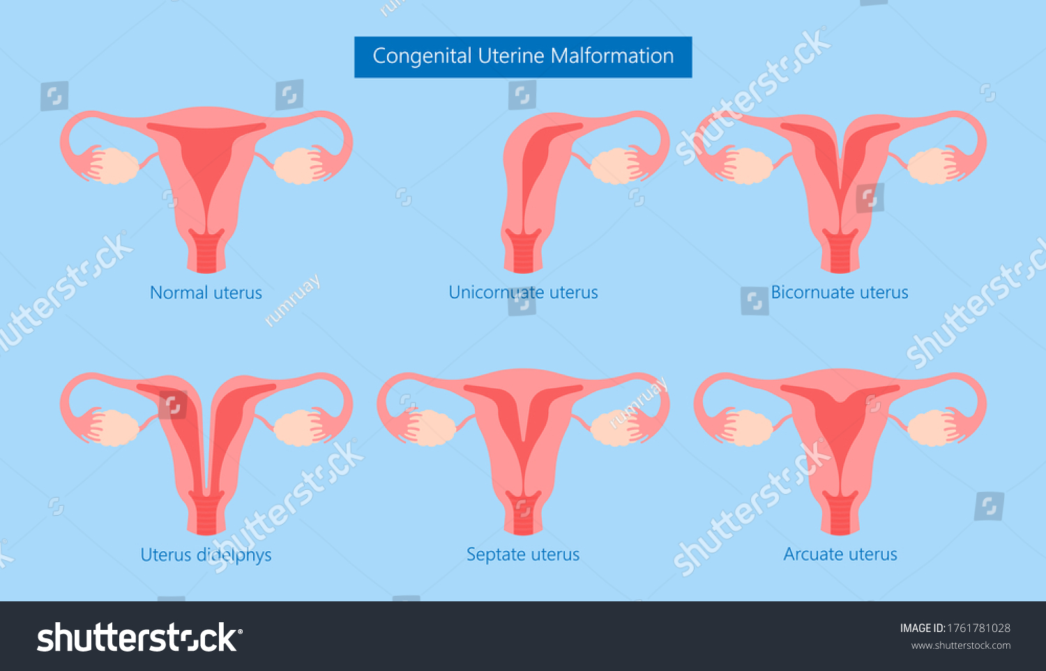 Abnormal Uterus Tipped Septum Missed Mature Stock Vector Royalty Free 1761781028