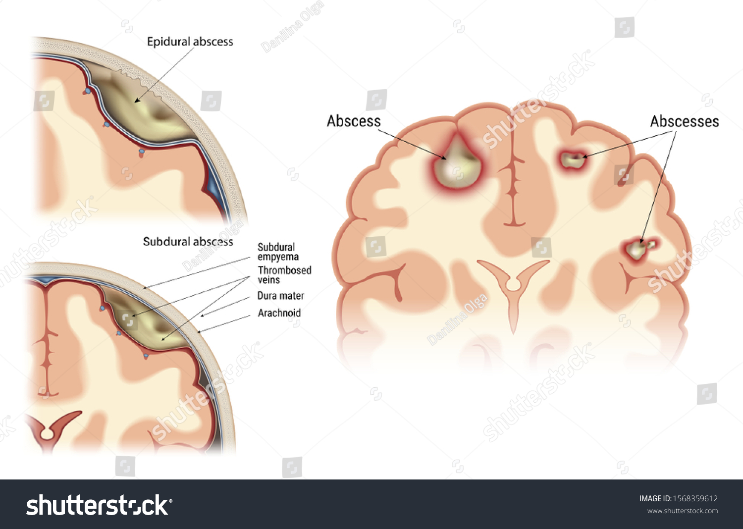 case study of brain abscess