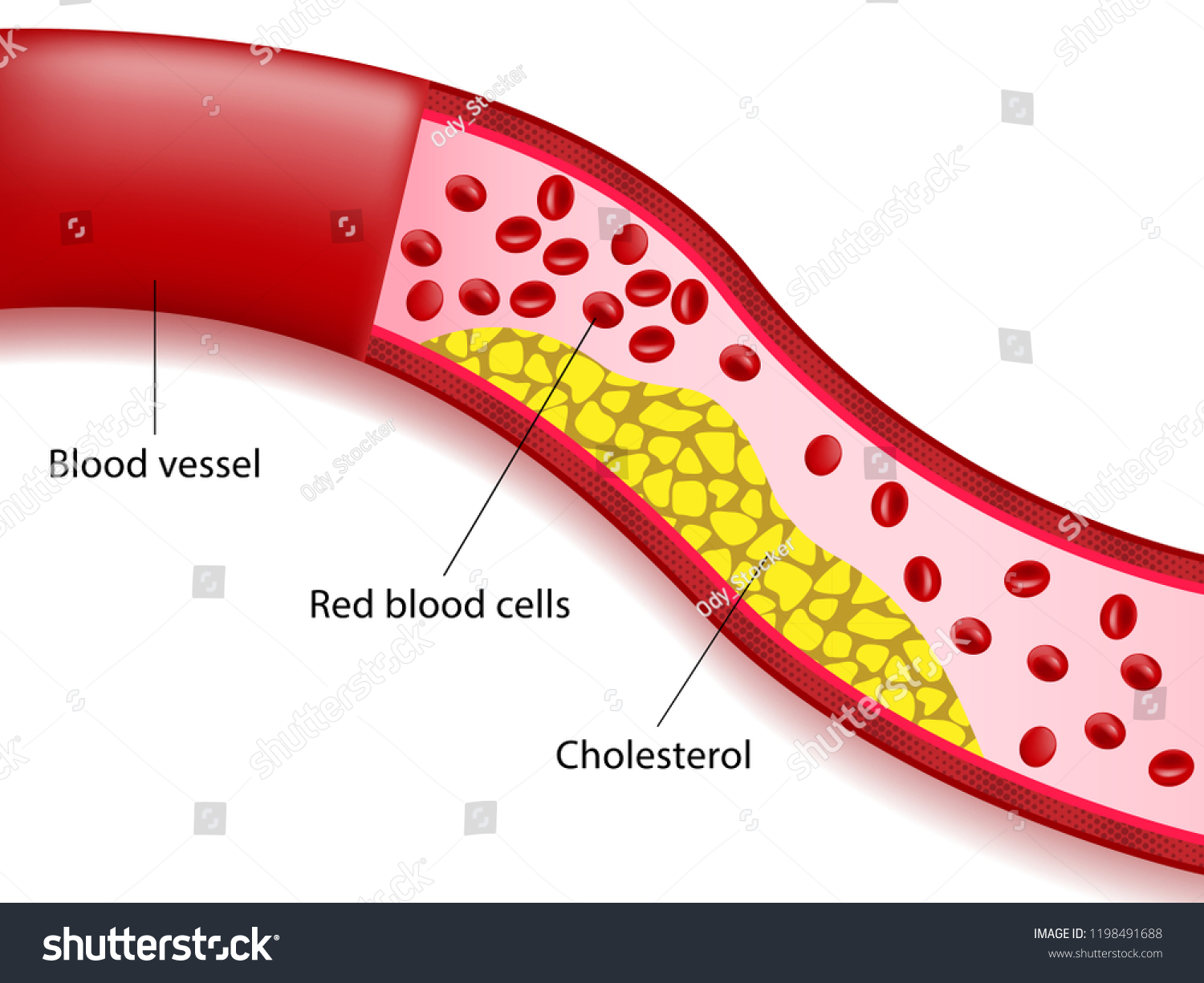 Accumulation Cholesterol Arteries Dyslipidemia Red Blood Stock Vector 