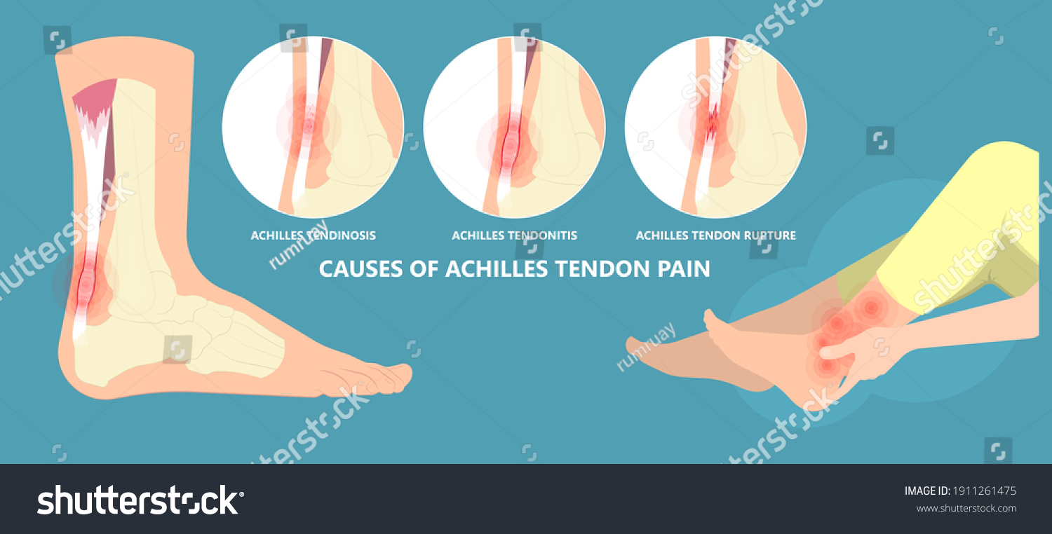 Achilles Tendon Rupture Injury Feet Calf Stock Vector (Royalty Free ...