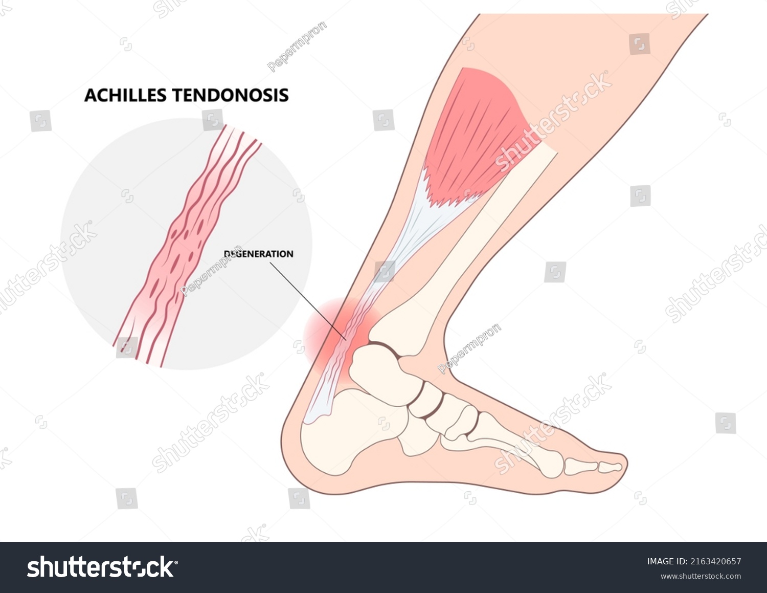 Achilles Tendon Rupture Injury Feet Calf Stock Vector (Royalty Free ...