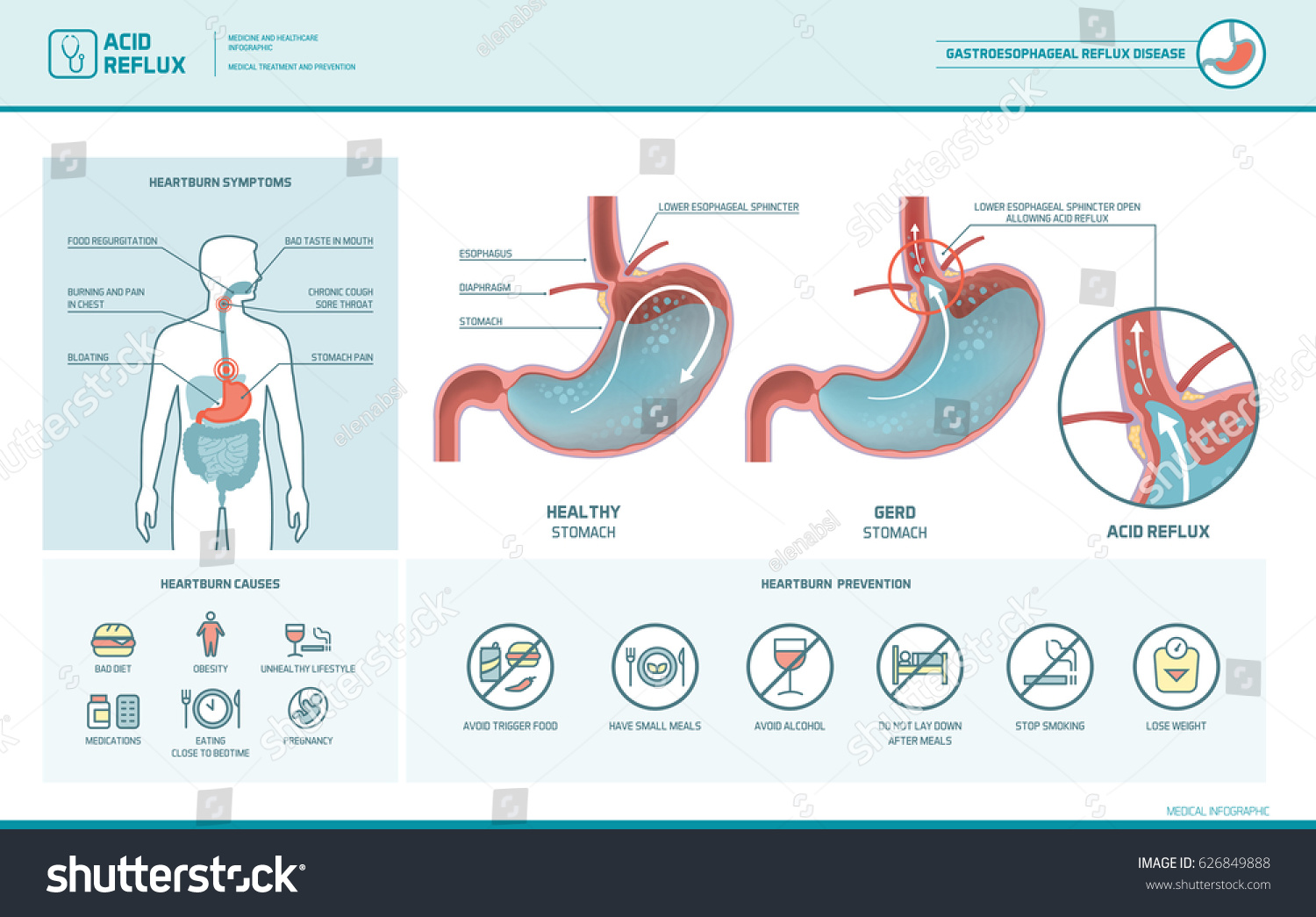 Acid Reflux Heartburn Gerd Infographic Stomach Stock Vector 626849888 