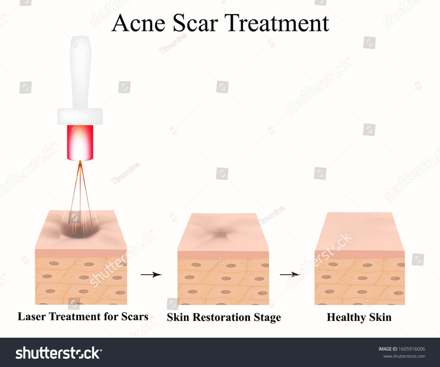 Acne Scars Laser Scar Atrophic Treatment Stock Vector (Royalty Free ...