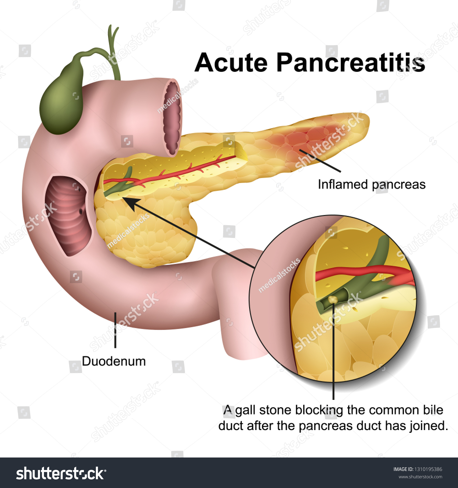 Acute Pancreatitis 3d Medical Vector Illustration Stock Vector Royalty Free 1310195386