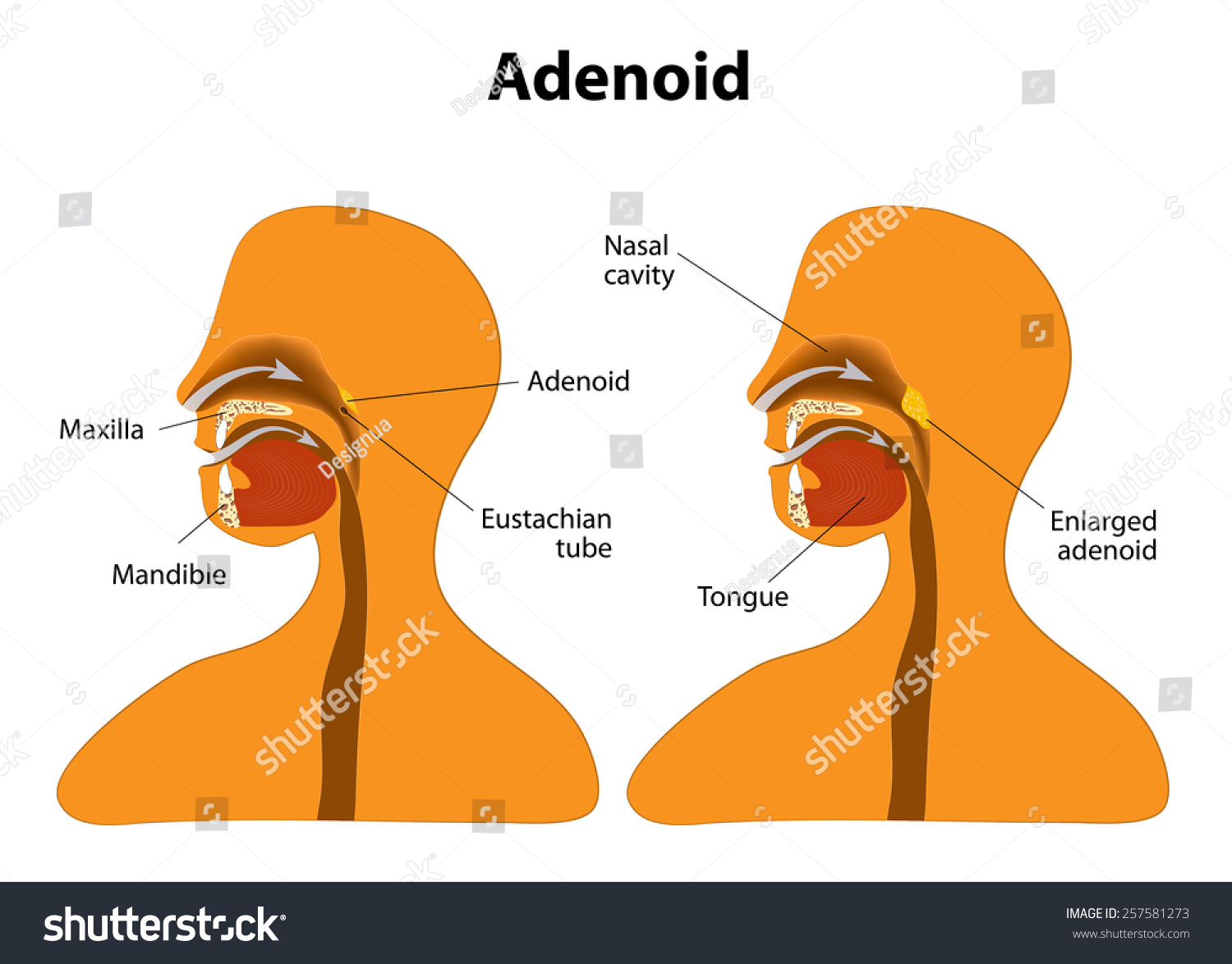 Adenoid Side View Show Position Adenoids เวกเตอร์สต็อก 257581273