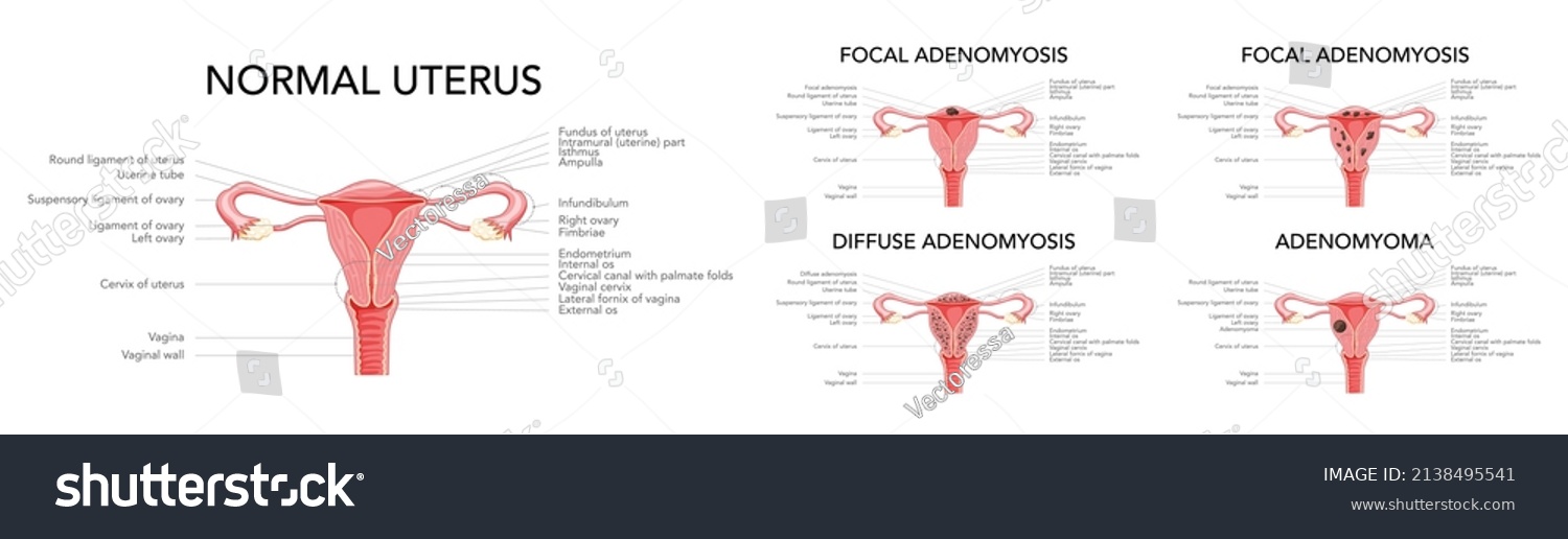 Adenomyosis Illness Set Focal Diffuse Adenomyoma Stock Vector (Royalty ...