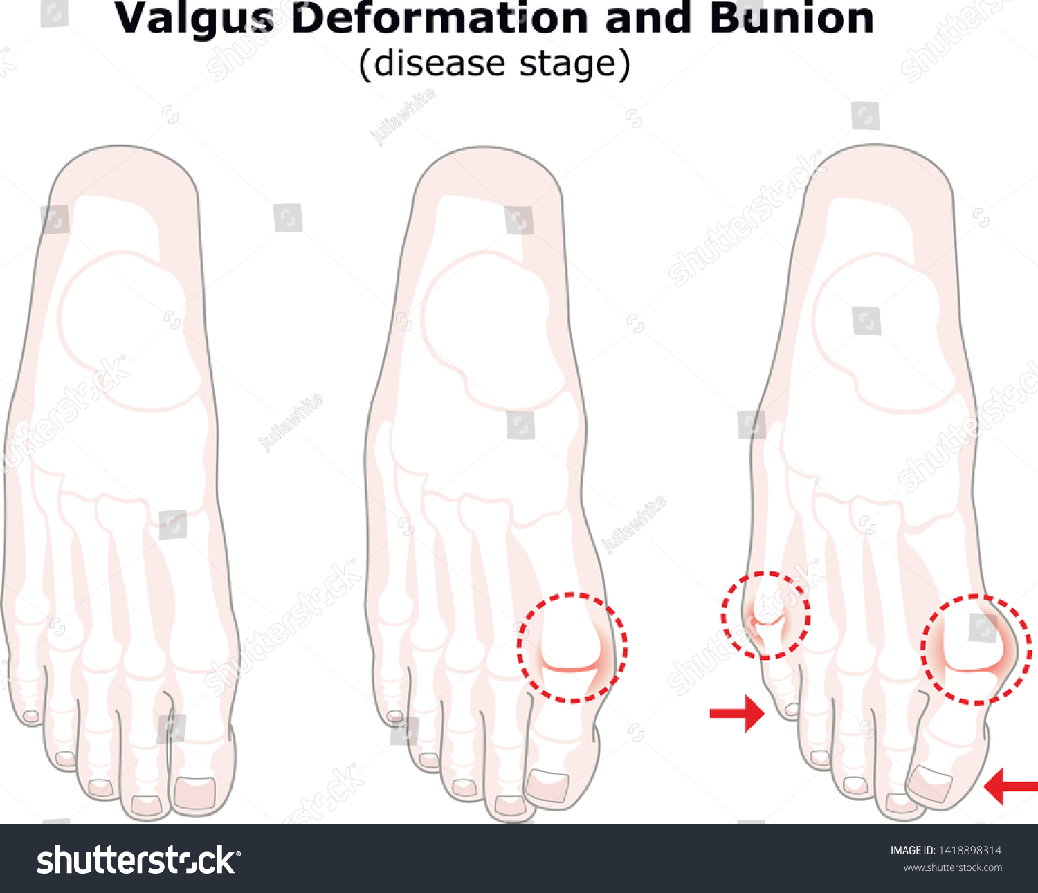 Age Valgus Deformity Thumb Bunion Stages