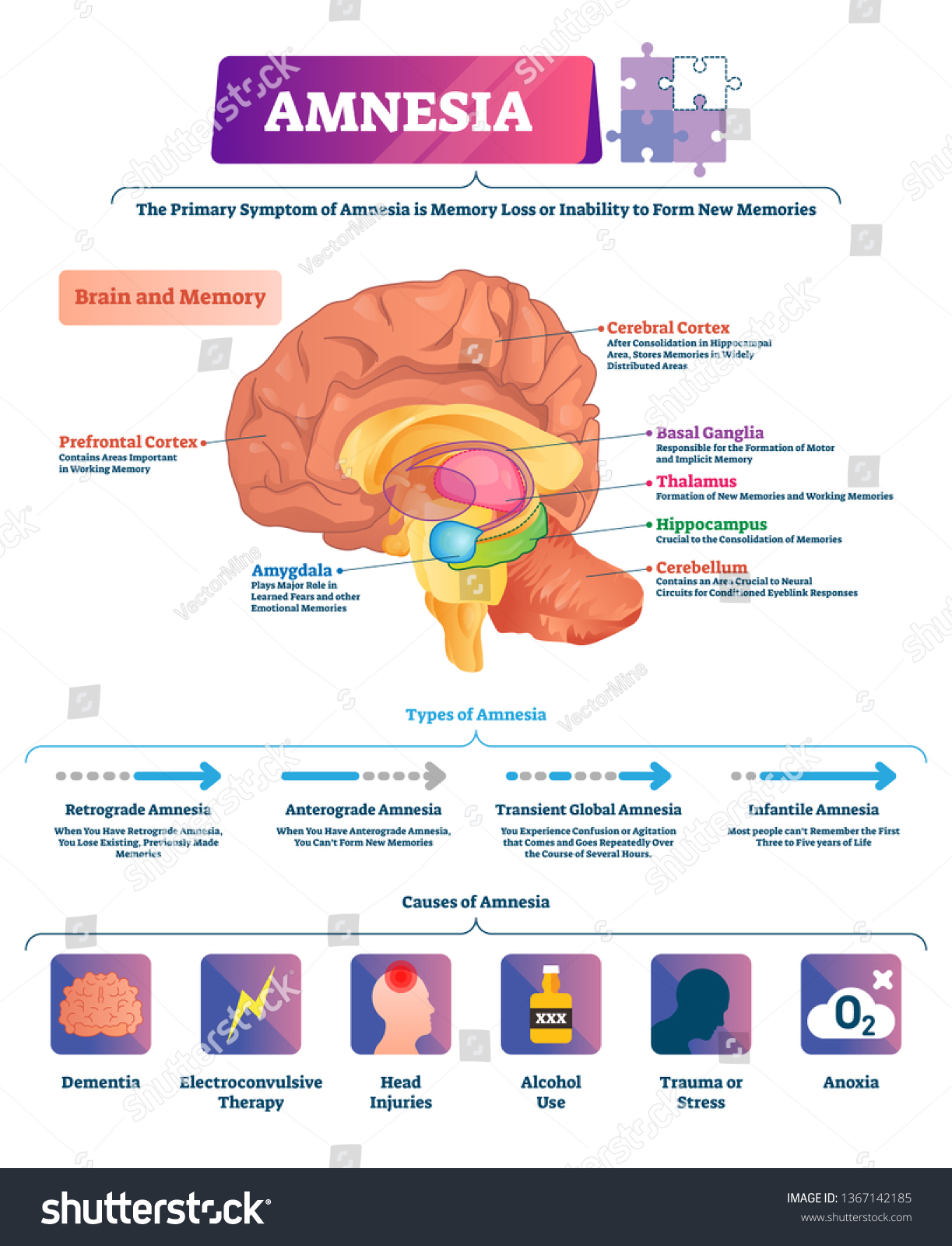 What Part Of The Brain Stores Memory >> Amnesia Vector Illustration Labeled Brain Memory Stok Vektor What Part Of The Brain Stores Memory >> Amnesia Vector Illustration Labeled Brain Memory Stok Vektor