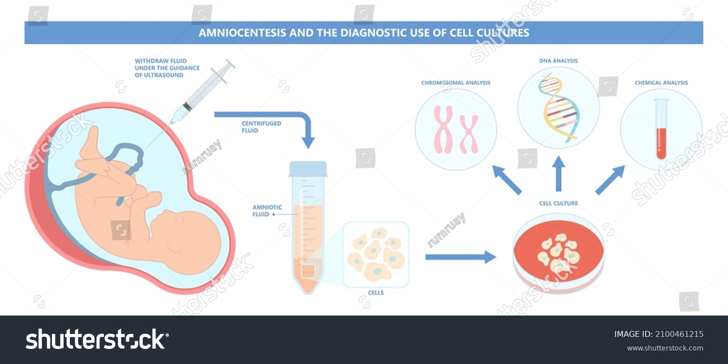 Amniocentesis Diagnostic Test Treat Lab Analysis Stock Vector Royalty Free 2100461215 1483