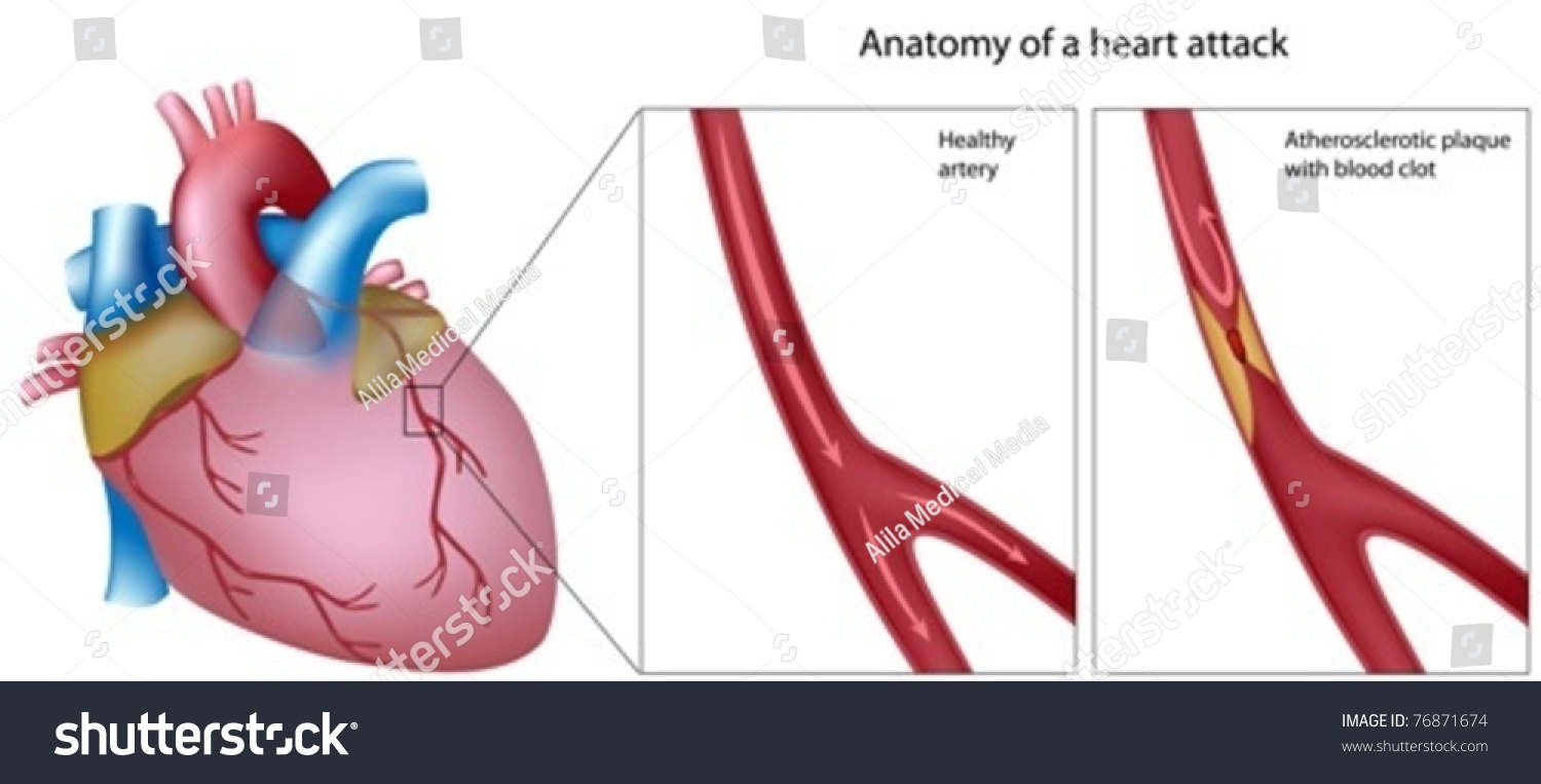 Anatomy Of A Heart Attack Stock Vector Illustration 76871674 : Shutterstock