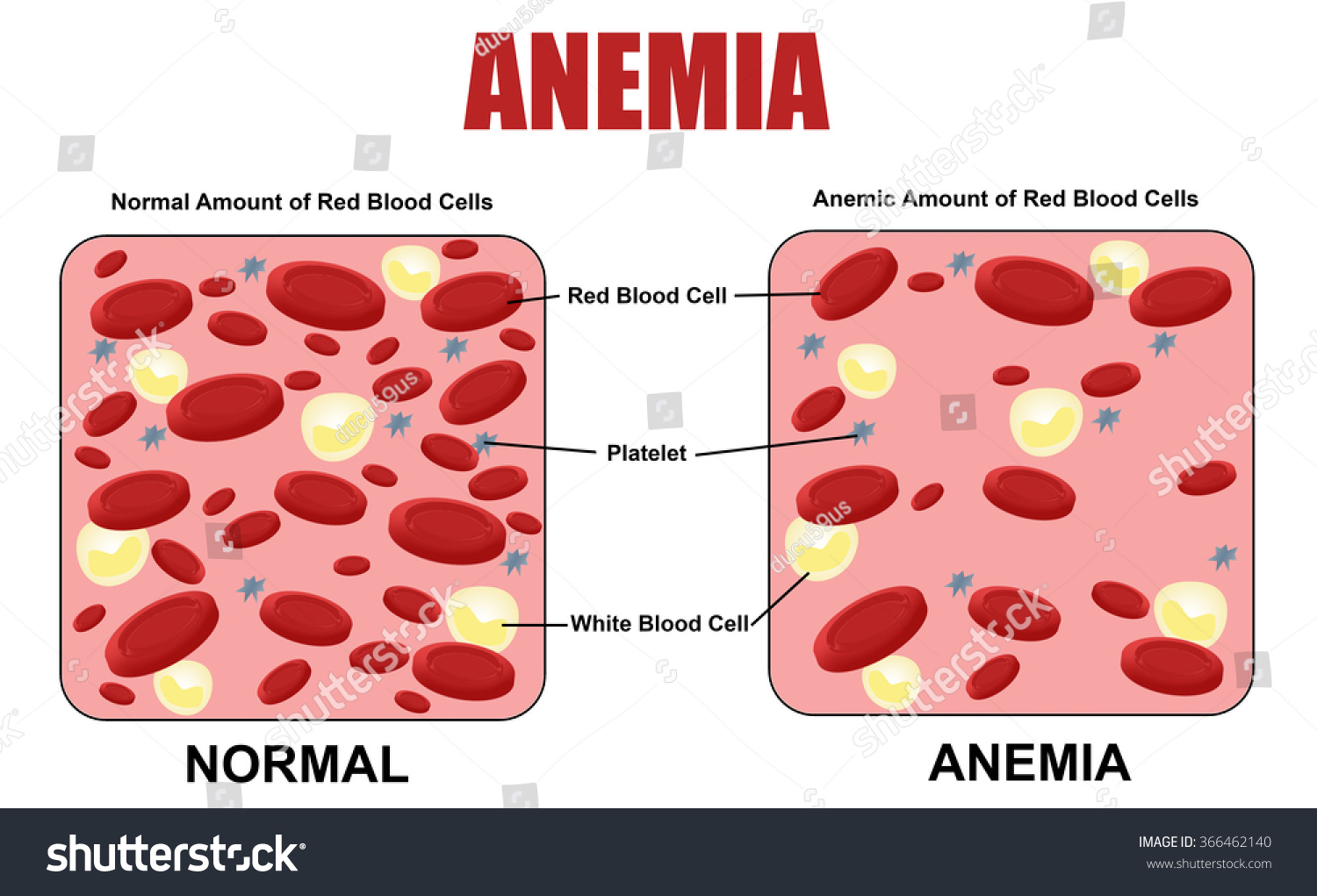 Anemia Diagram, Vector Illustration (For Basic Medical Education, For ...