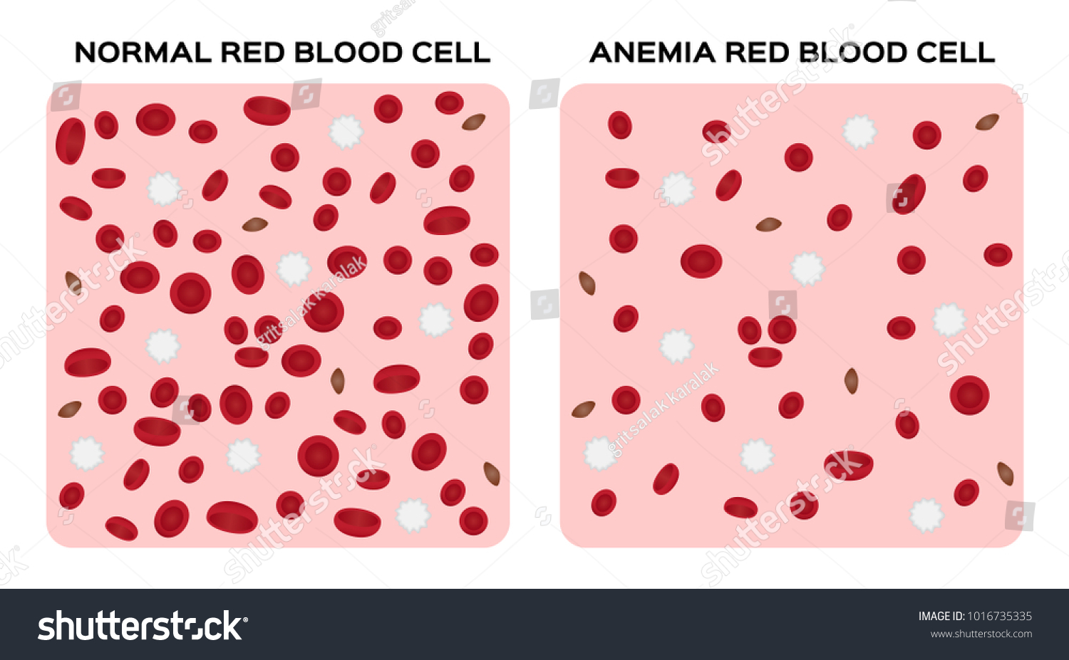 Anemia Vector Blood Anatomy Concept Stock Vector (Royalty Free ...