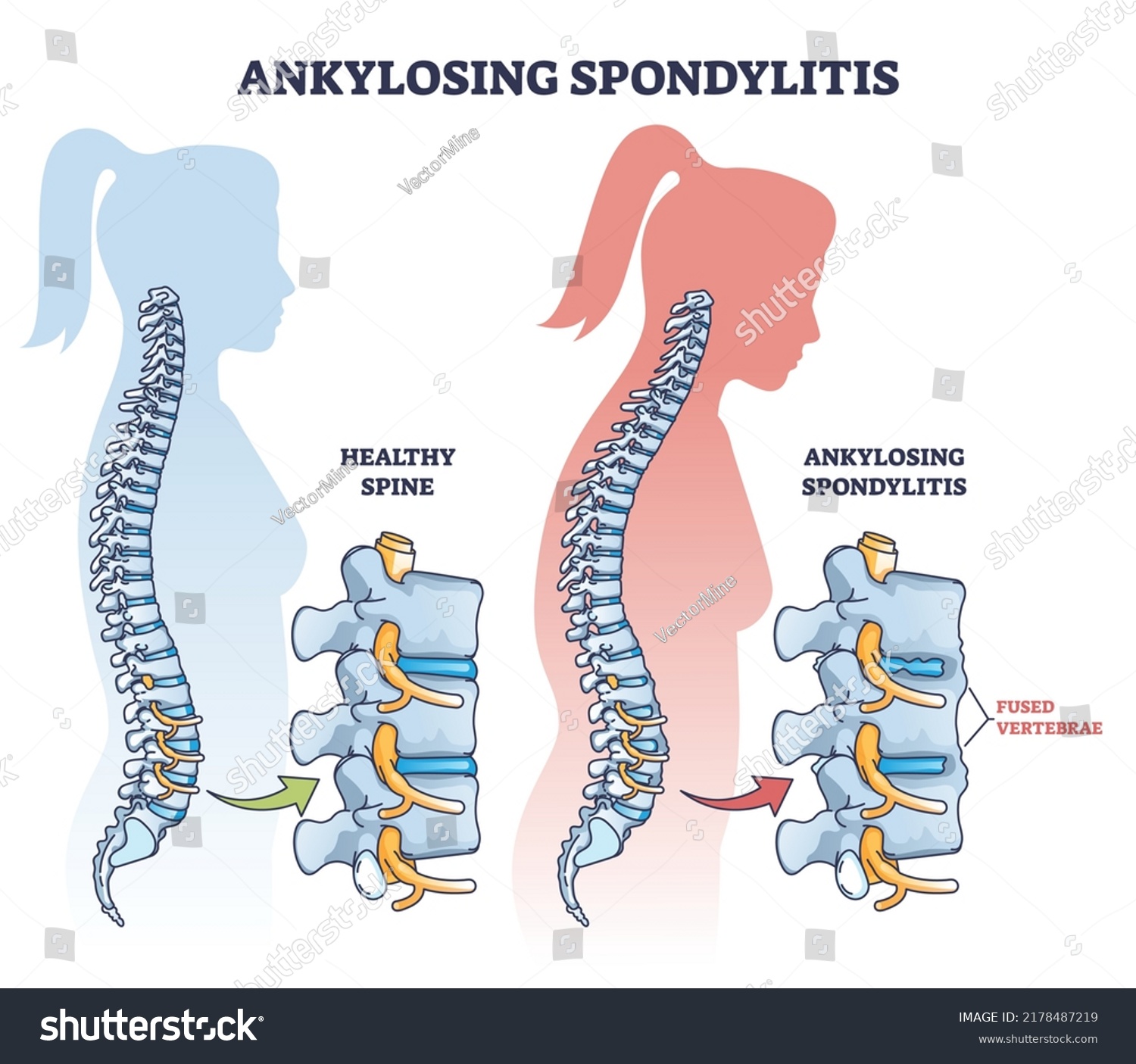 Ankylosing Spondylitis Inflammatory Spine Bone Disease Stock Vector ...