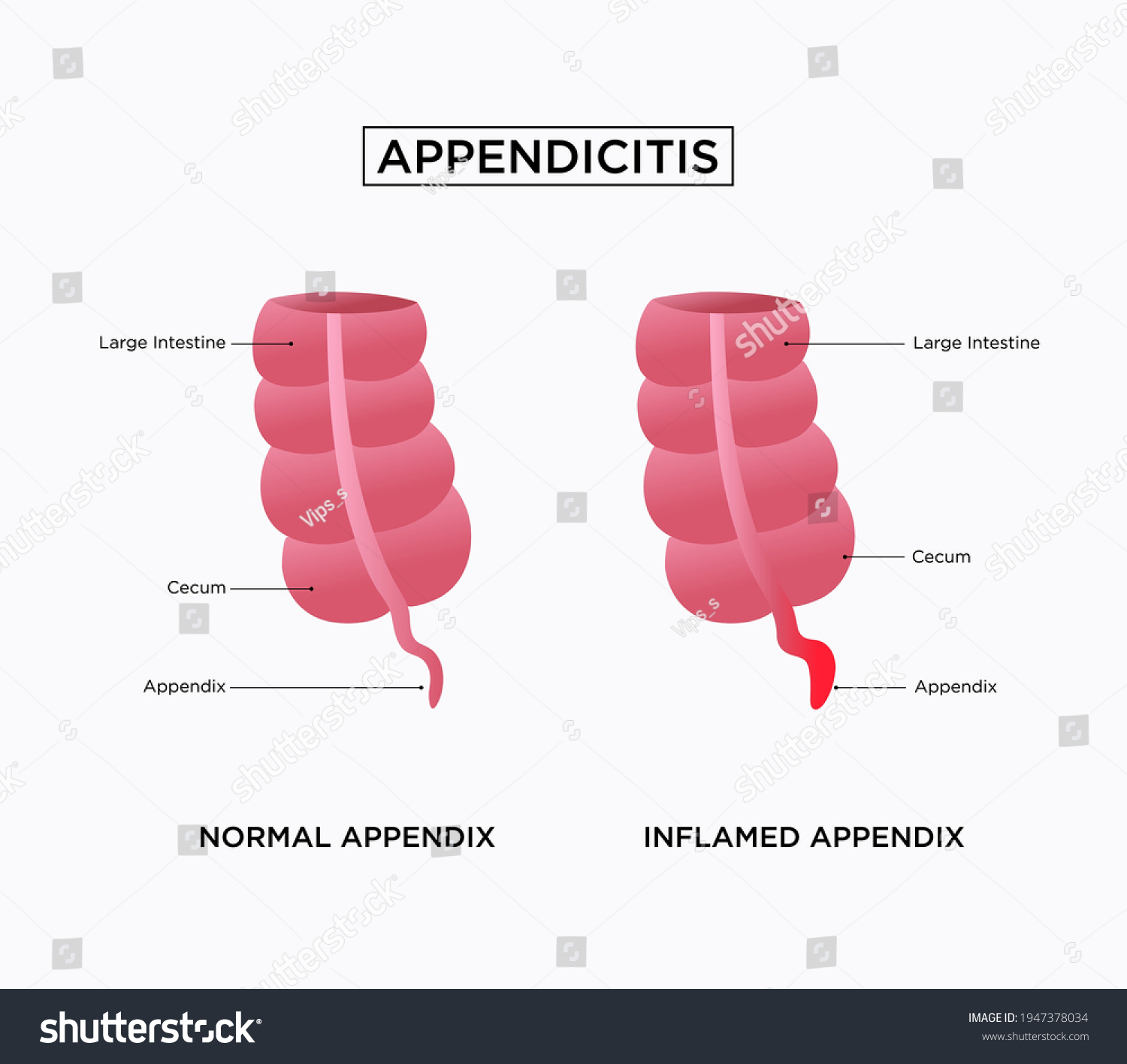 Appendicitis Appendicitis Inflammation Appendix Large Intestine Vector