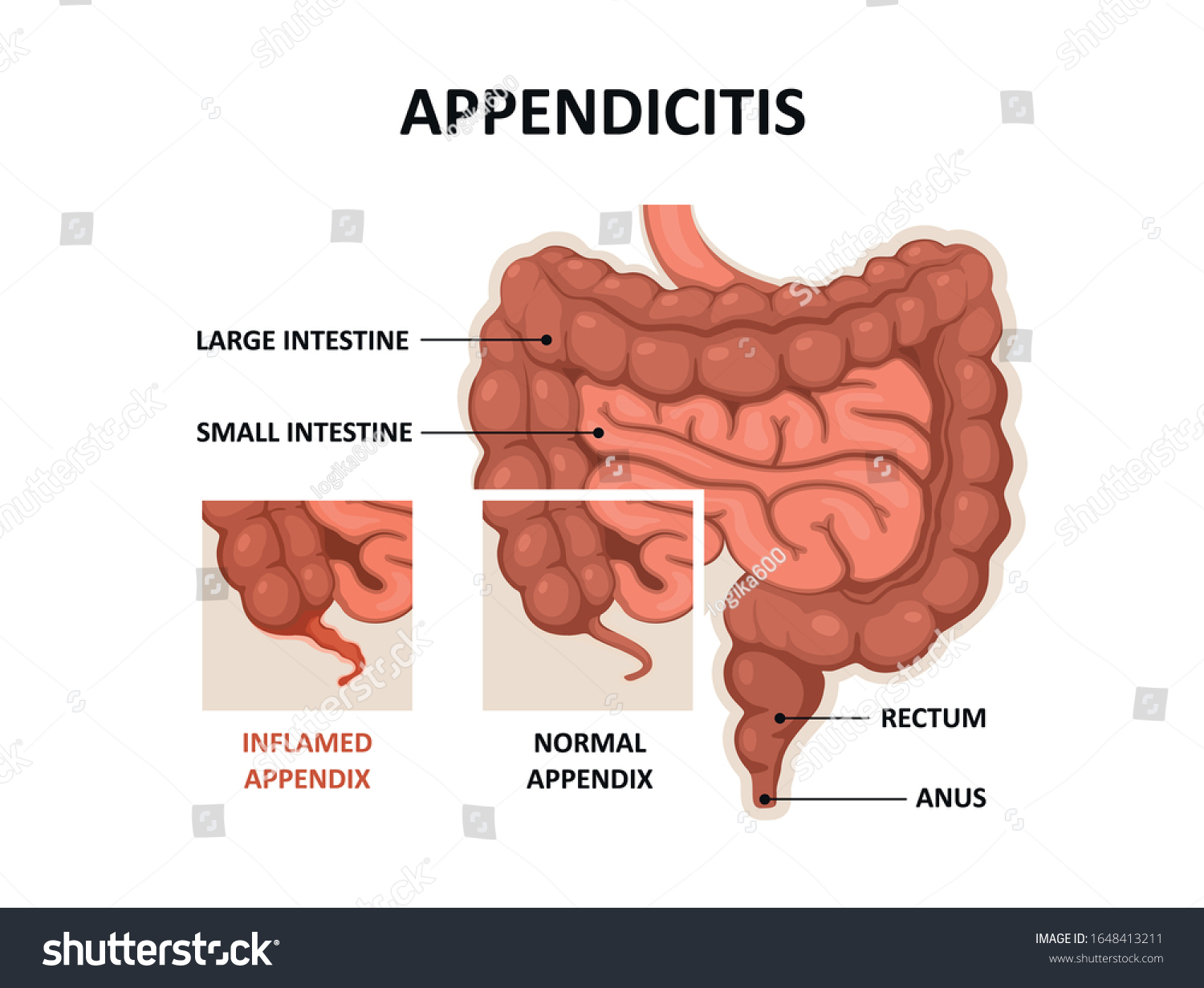 8,409 Appendicitis Images, Stock Photos & Vectors | Shutterstock