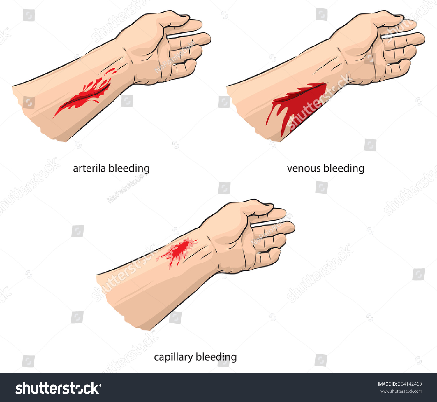 Arterial And Venous Bleeding Stock Vector Illustration 254142469 ...