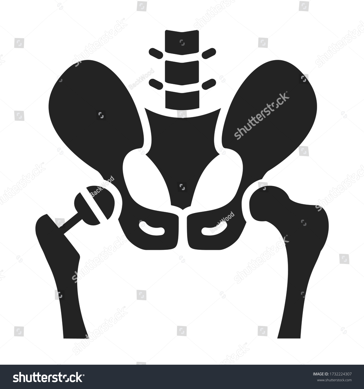 Arthroplasty Glyph Black Icon Hip Replacement Stock Vector (Royalty ...