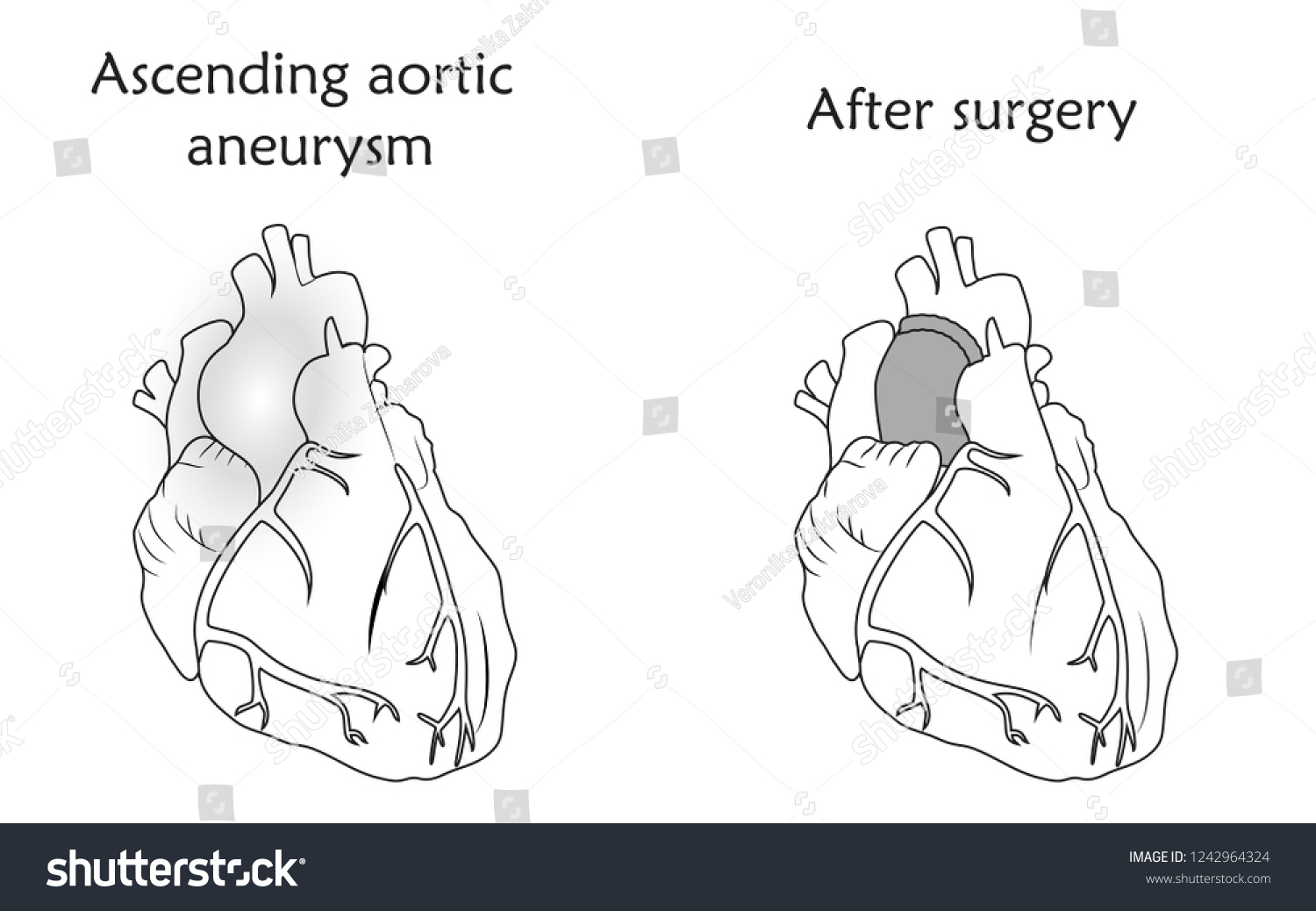 Vektor Stok Ascending Aortic Aneurysm Before After Repair Tanpa Royalti 1242964324 Shutterstock 1056