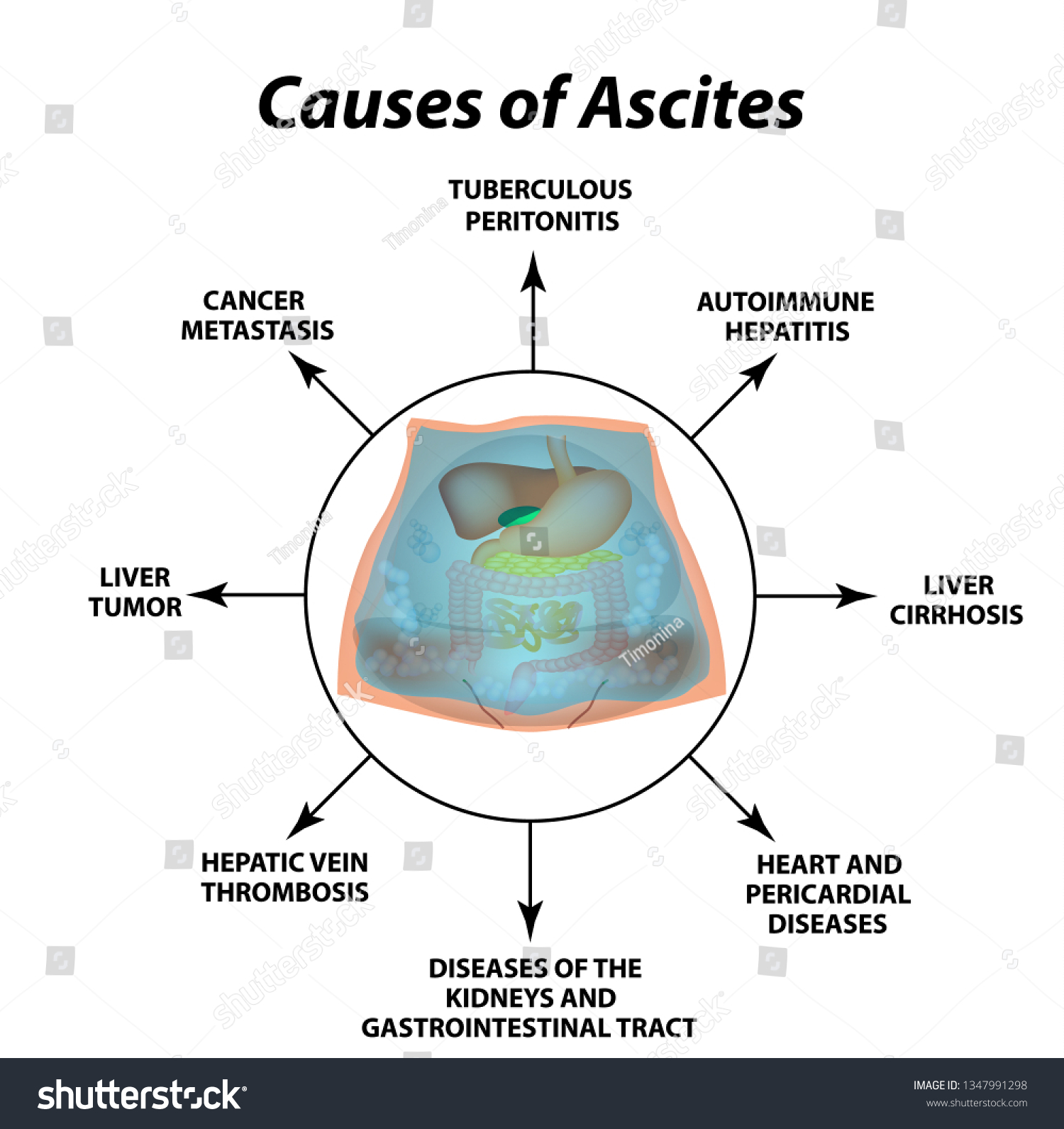 Ascites Free Fluid Abdominal Cavity Infographics Stock Vector (Royalty ...