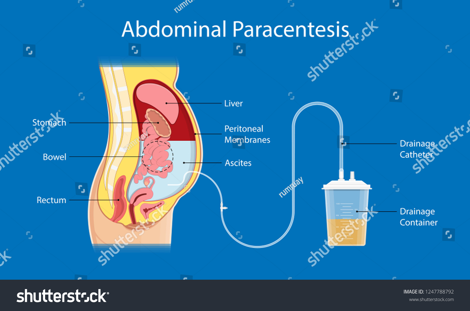 Paracentesis images stock photos vectors shutterstock