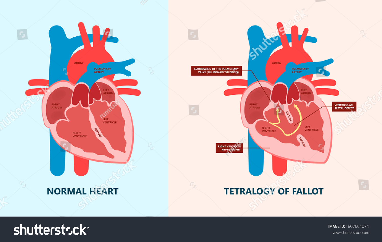 Adalah asd jantung Ventricular Septal