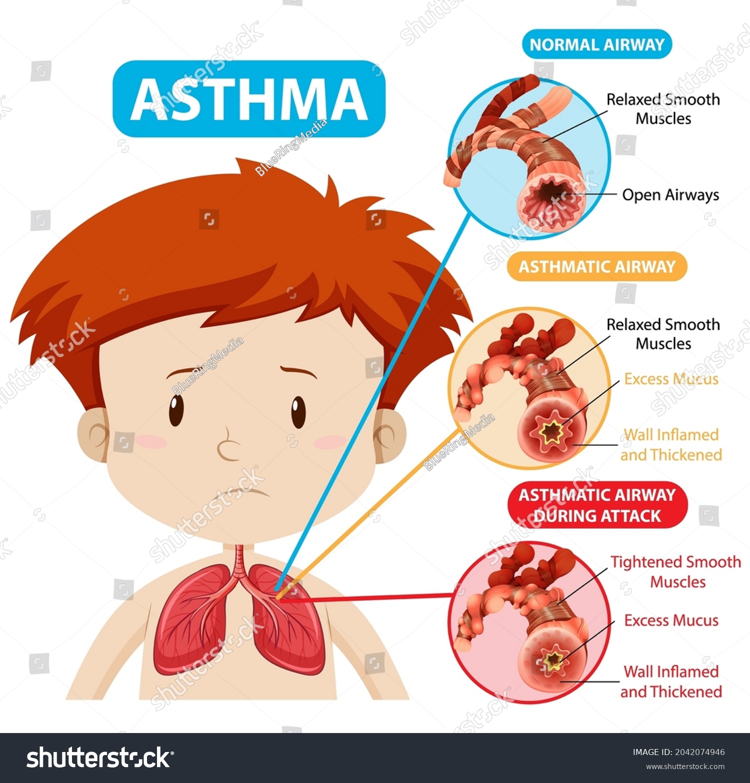 Asthma Diagram Normal Airway Asthmatic Airway Stock Vector (Royalty ...