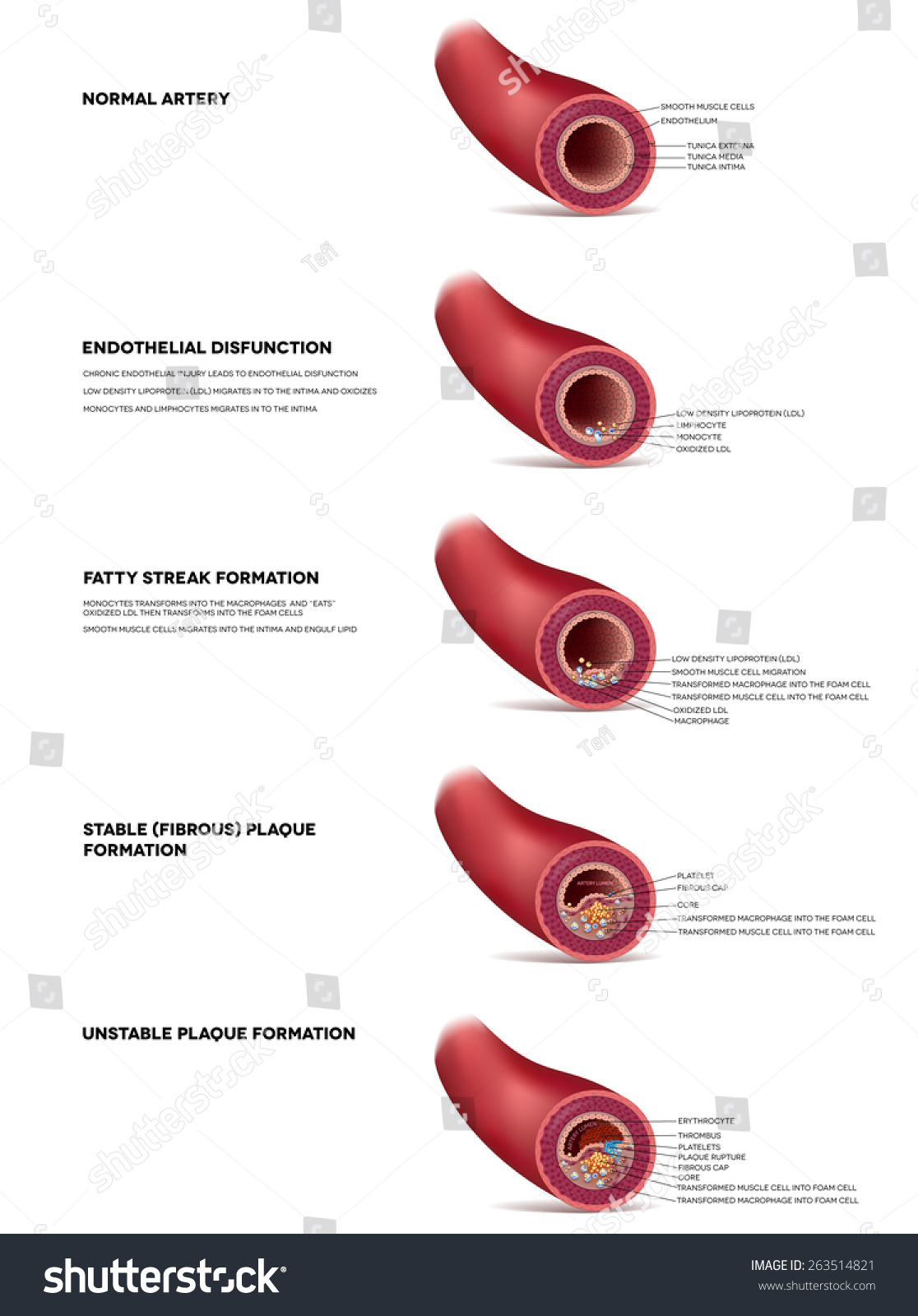 Atherosclerosis Detailed Illustration Progression Till Thrombus Stock ...