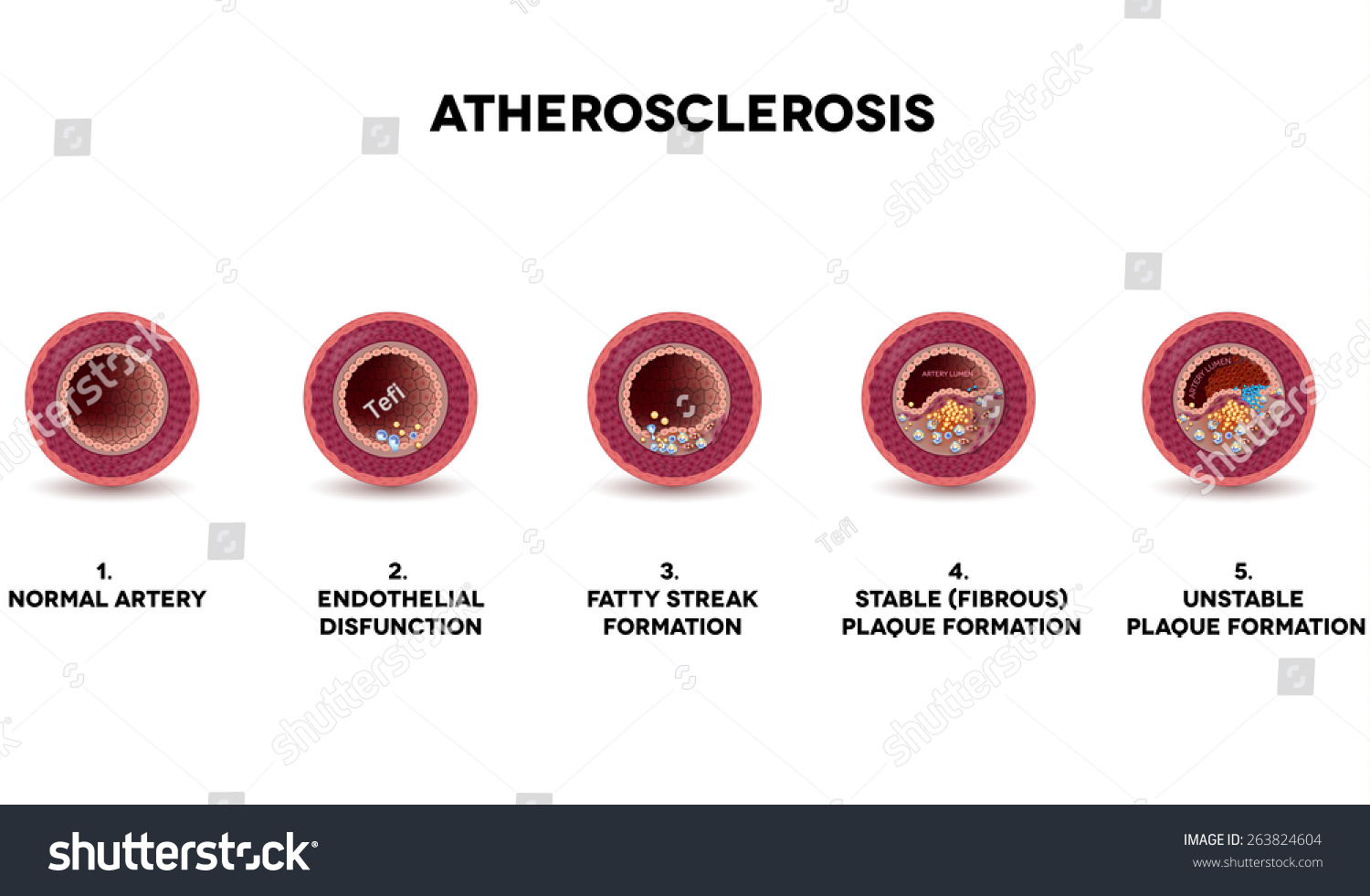 Atherosclerosis Formation Healthy Artery And Unhealthy Arteries My