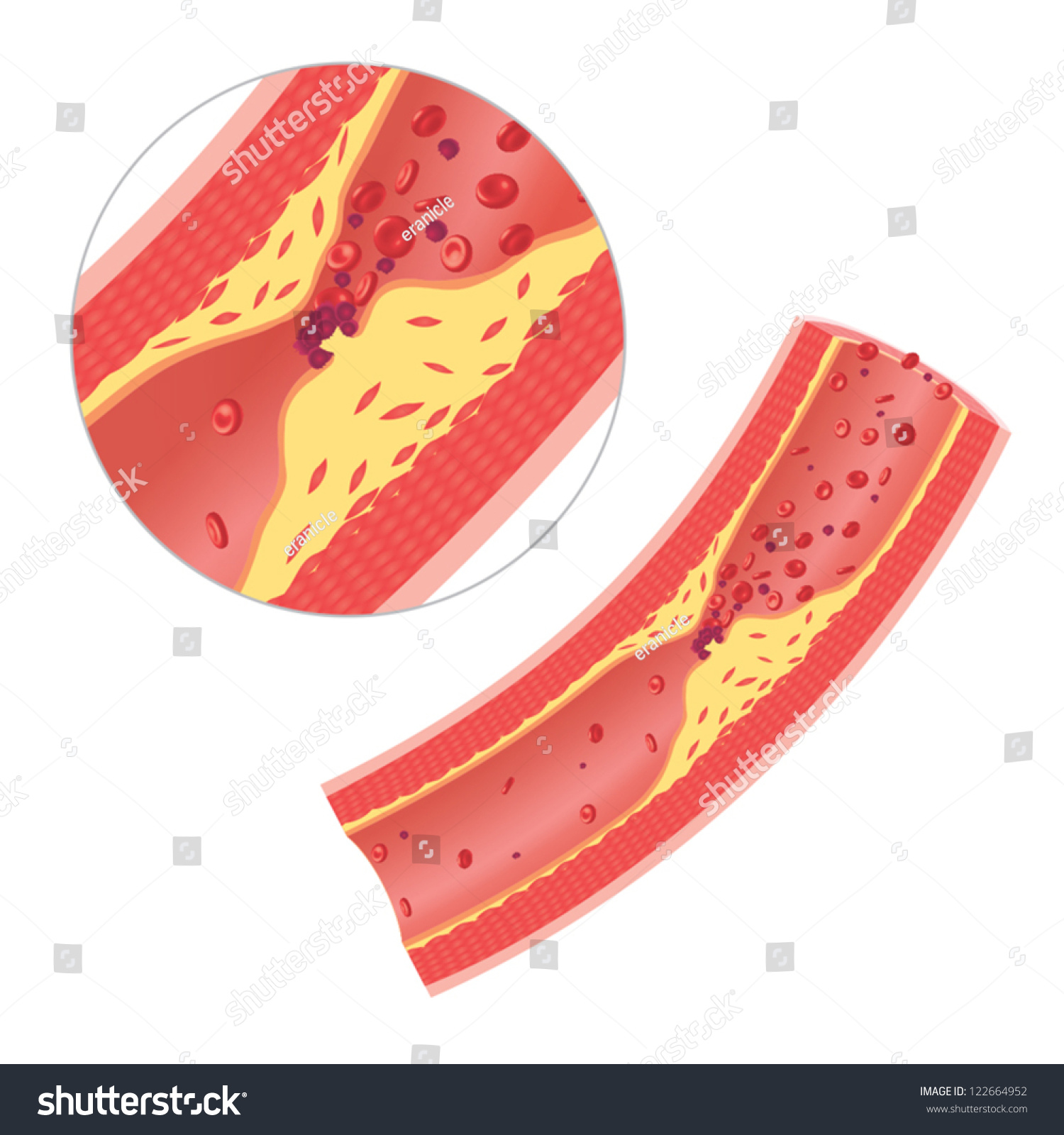 Atherosclerosis Artery Caused By Cholesterol Plaque Stock Vector ...