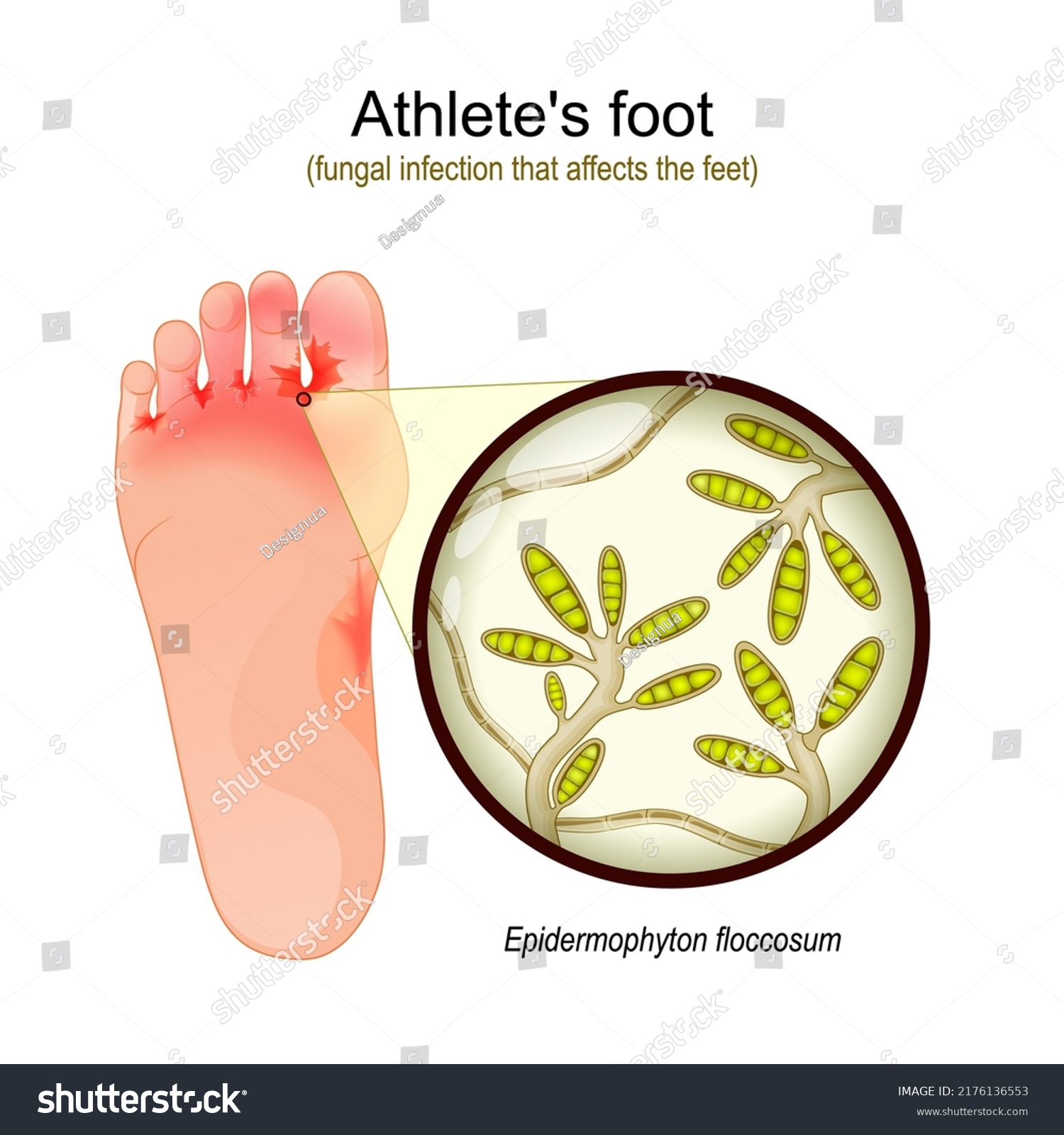 Athletes Foot Fungal Infection That Affects Stock Vector (Royalty Free ...