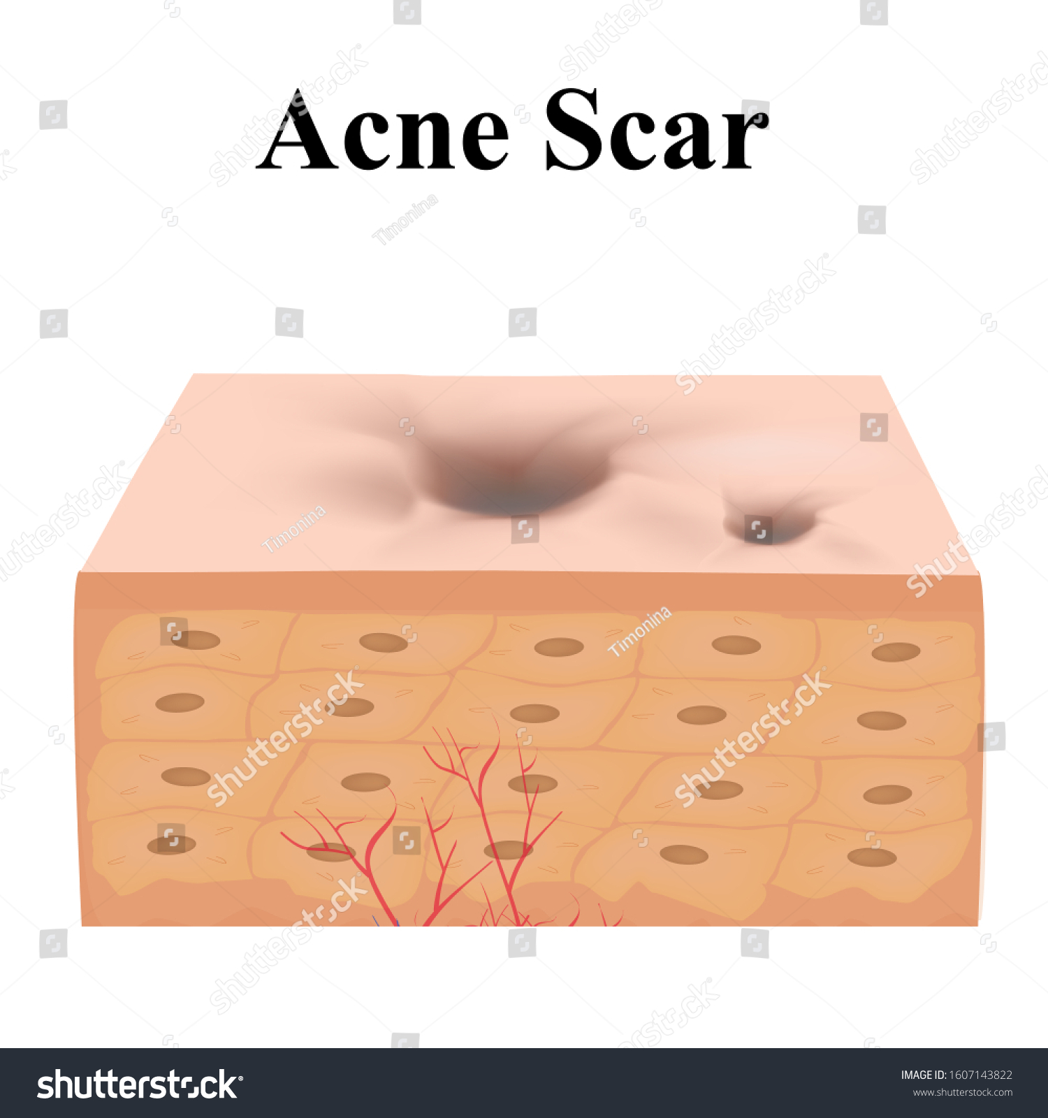 Atrophic Scars Acne Scar Anatomical Structure Stock Vector (Royalty ...