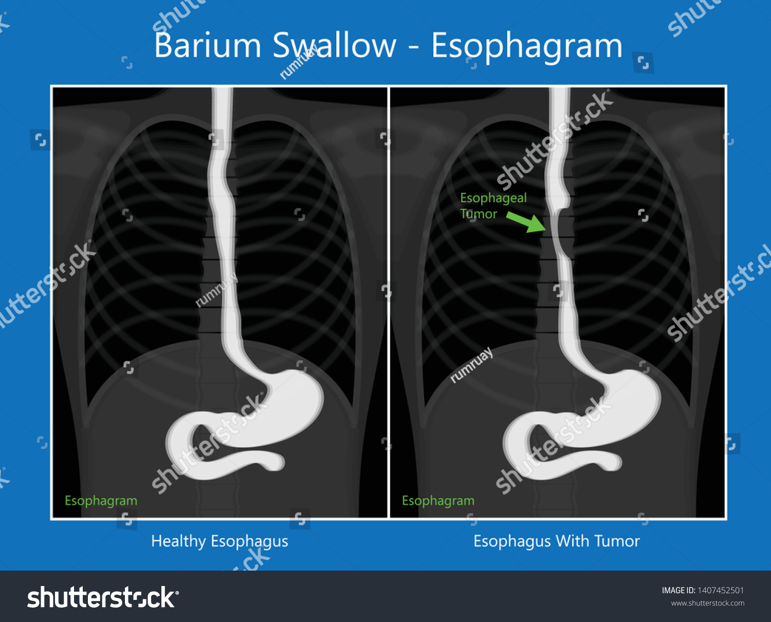 barium-swallow-study-test-diagnose-barretts-stok-vekt-r-telifsiz