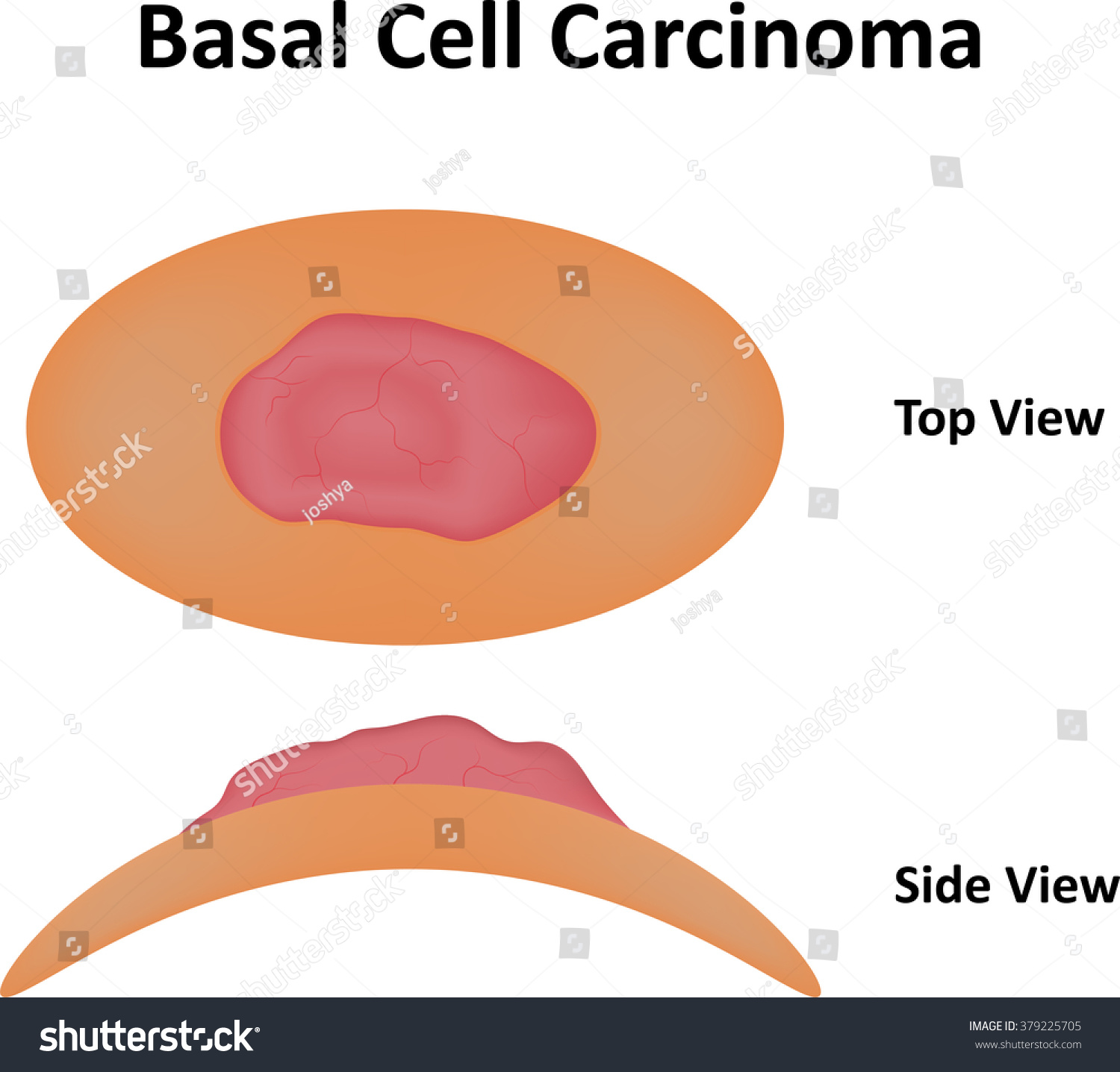 Basal Cell Carcinoma Stock Vector 379225705 - Shutterstock