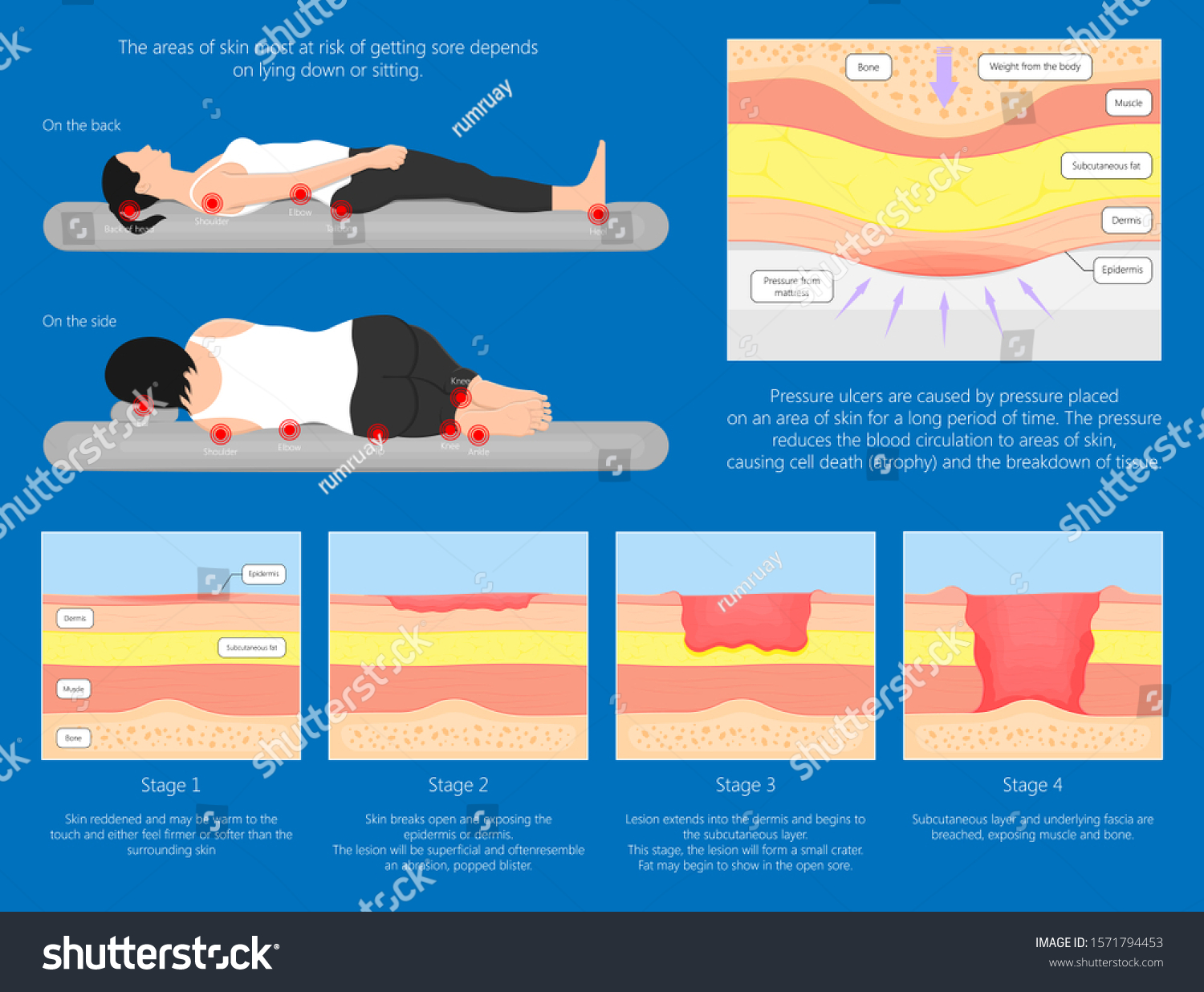 Bedsores Pressure Ulcers Injuries Skin Underlying Stock Vector (Royalty ...