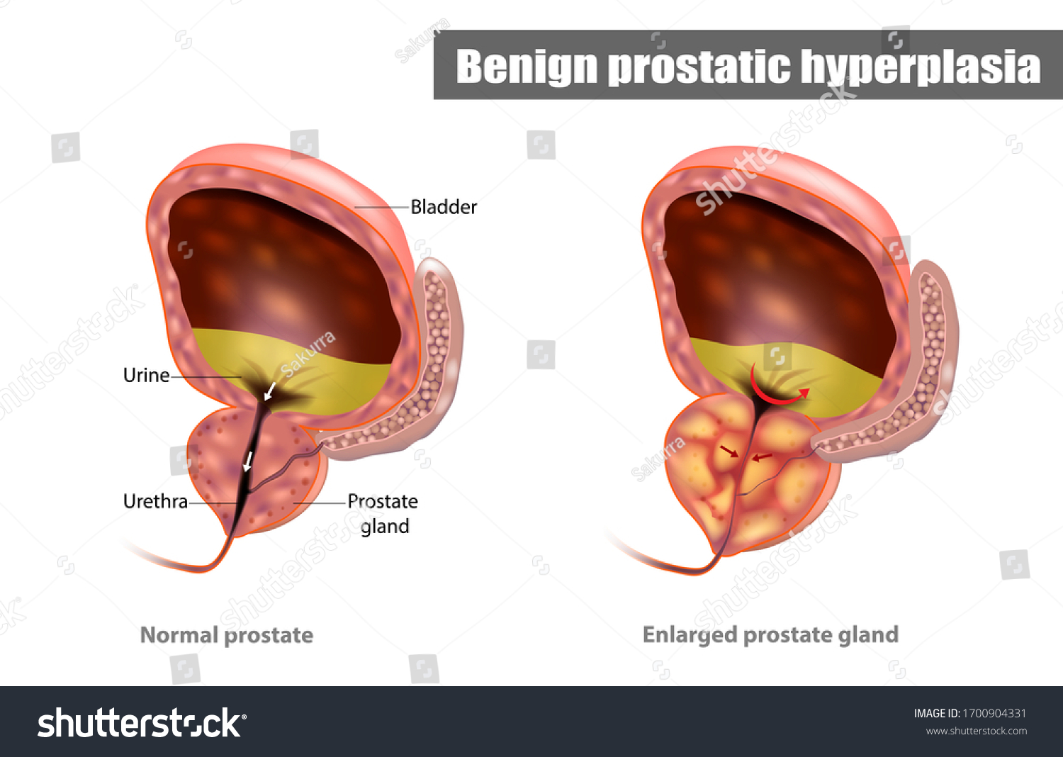 how to reduce prostate enlargement naturally
