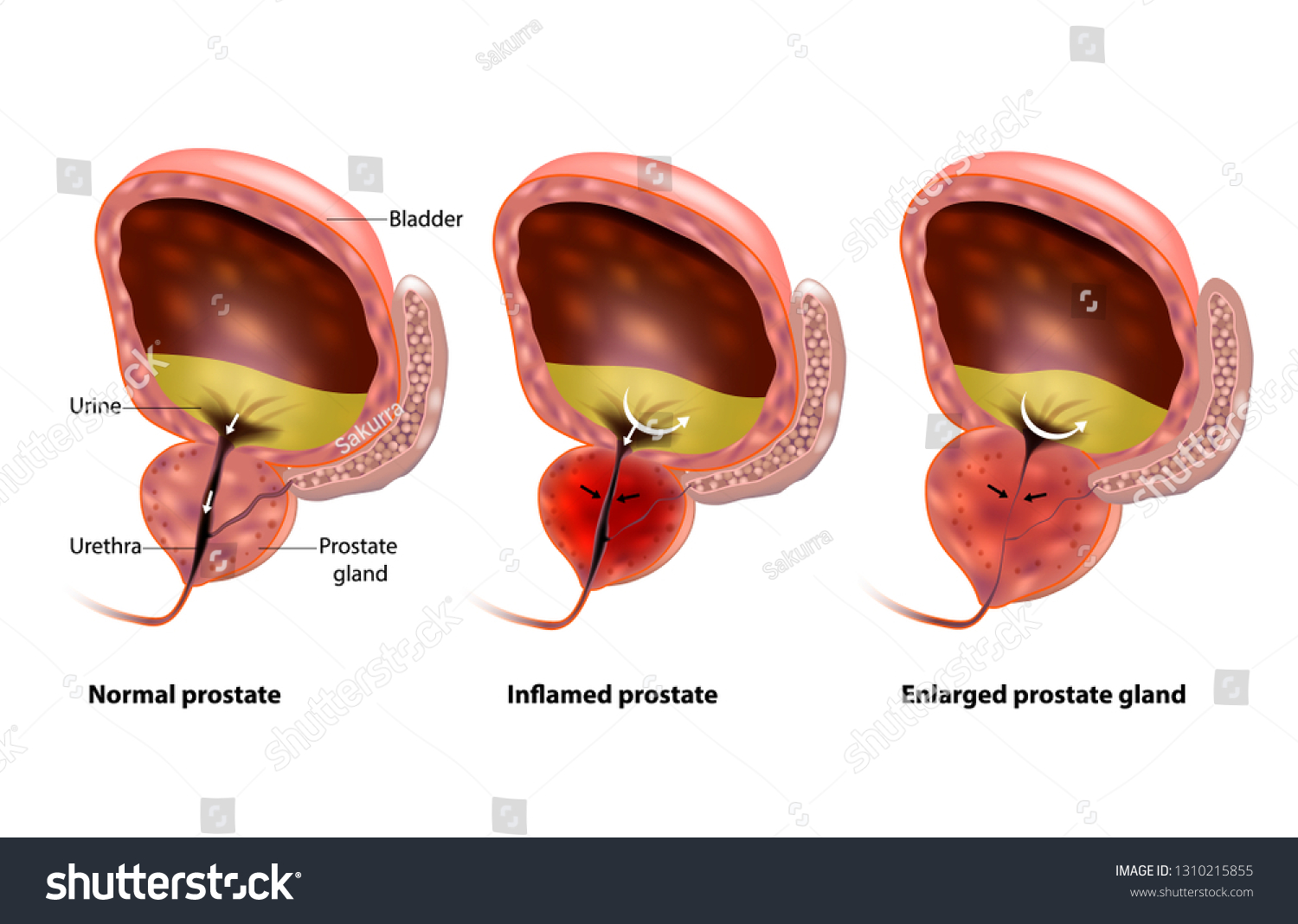benign prostatic hyperplasia( bph) izom izületi fájdalomcsillapító