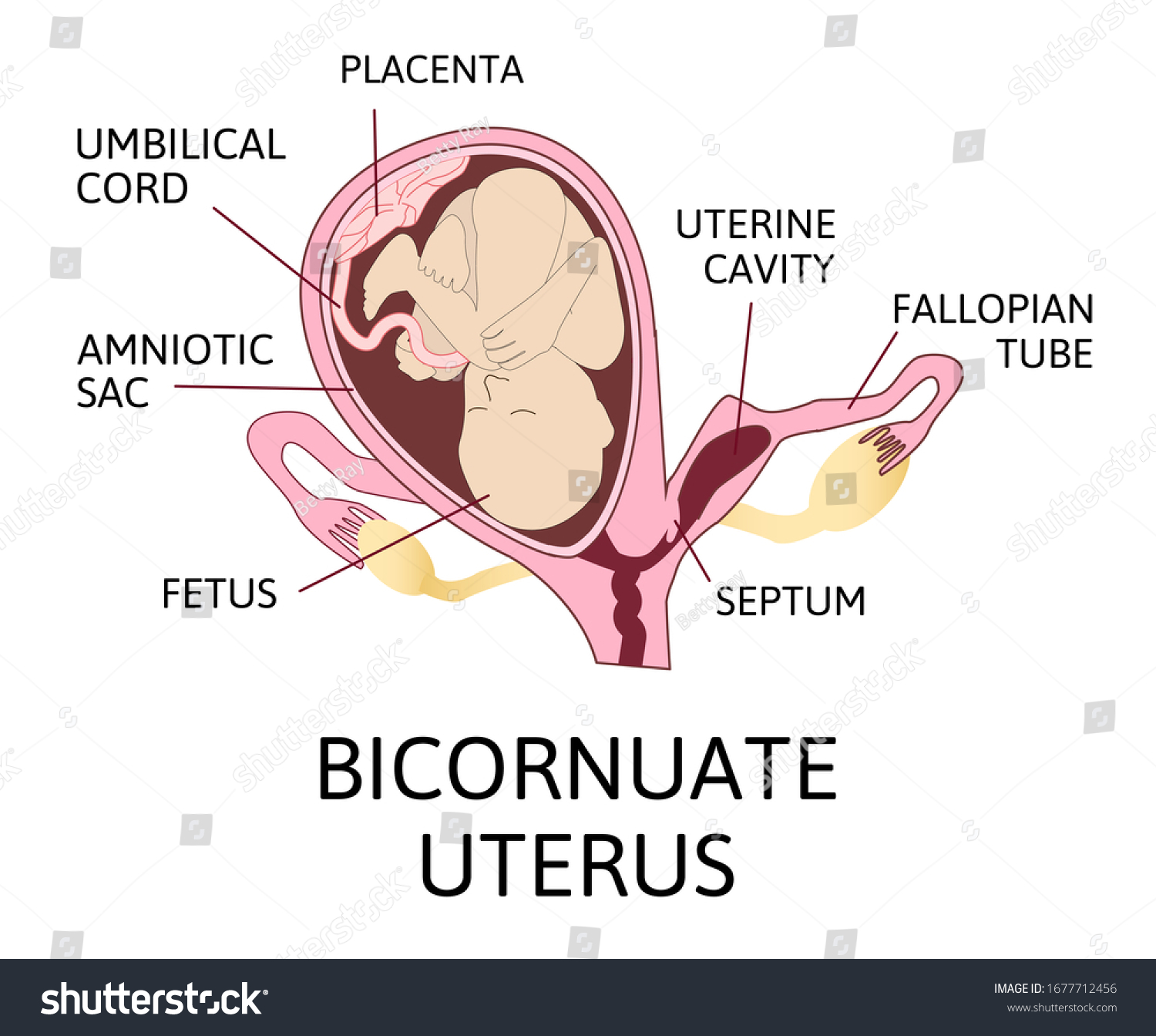 Bicornuate Uterus Pregnancy One Uterine Fetus Vector Có Sẵn Miễn Phí