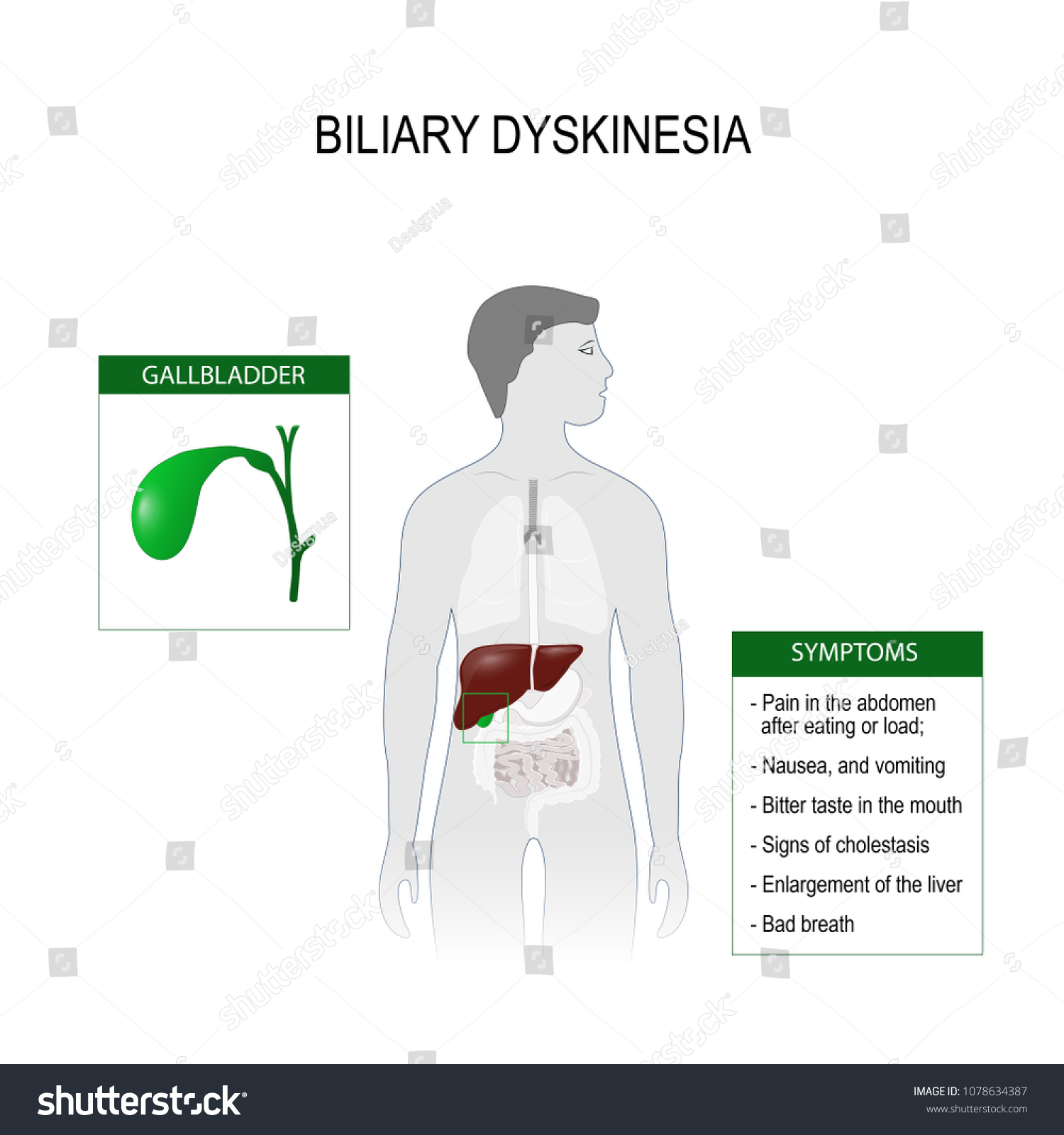 Biliary Dyskinesia Disorder Biliary Part Digestive Stock Vector Royalty Free 1078634387 0917