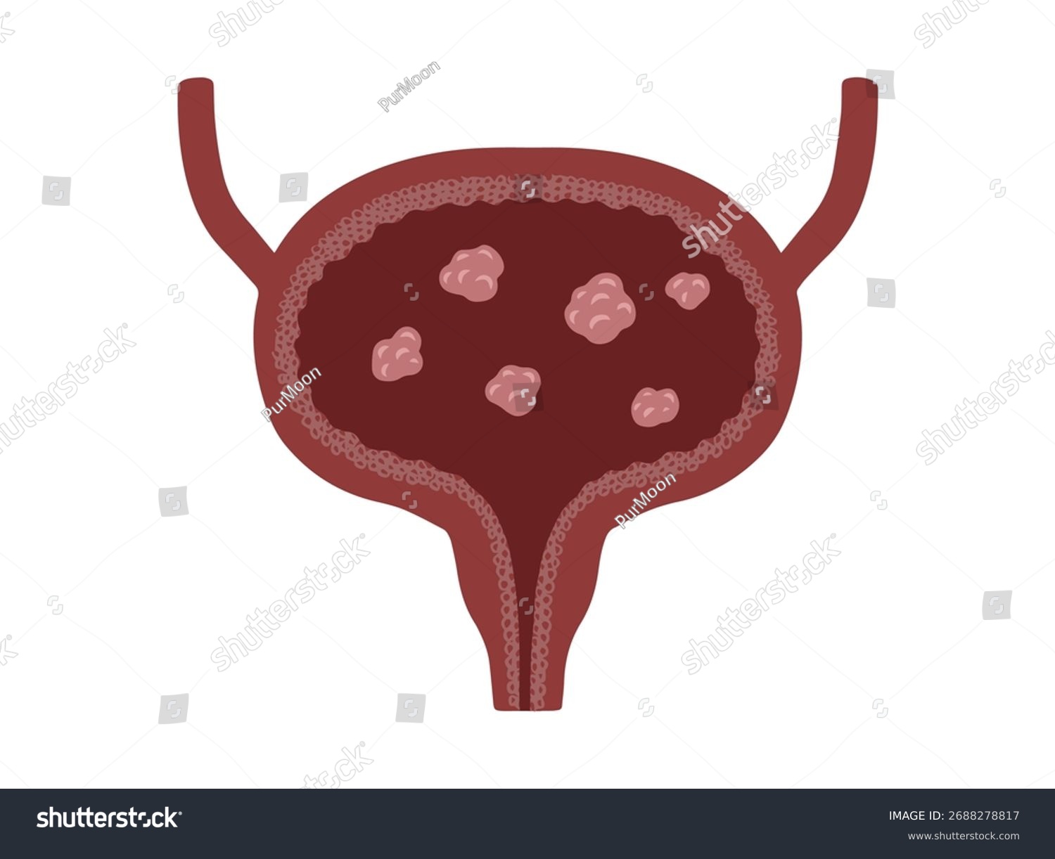 bladder with tumors, medical diagram clip art preview