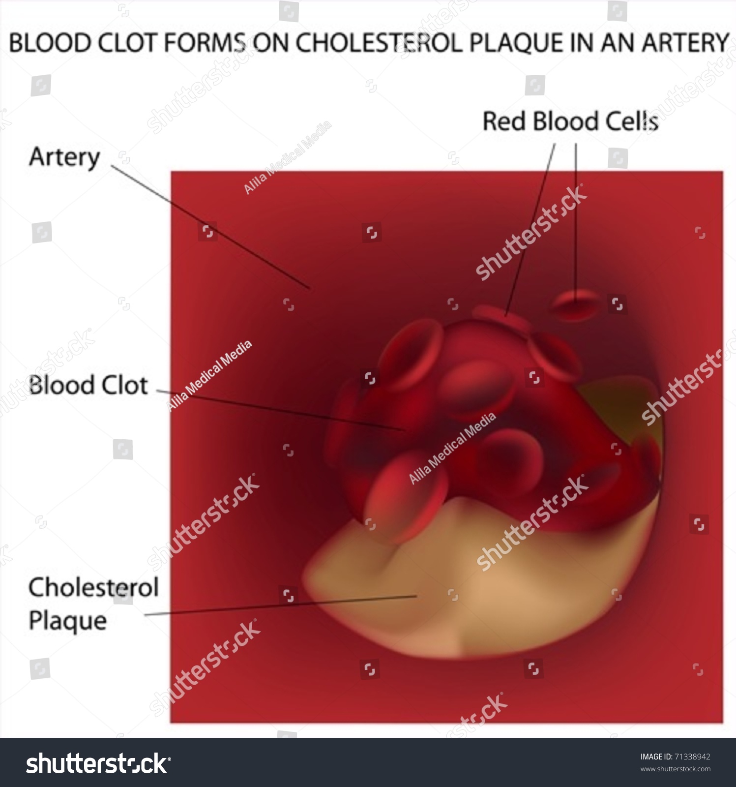 Blood Clot Forms On Cholesterol Plaque In Artery Stock Vector ...